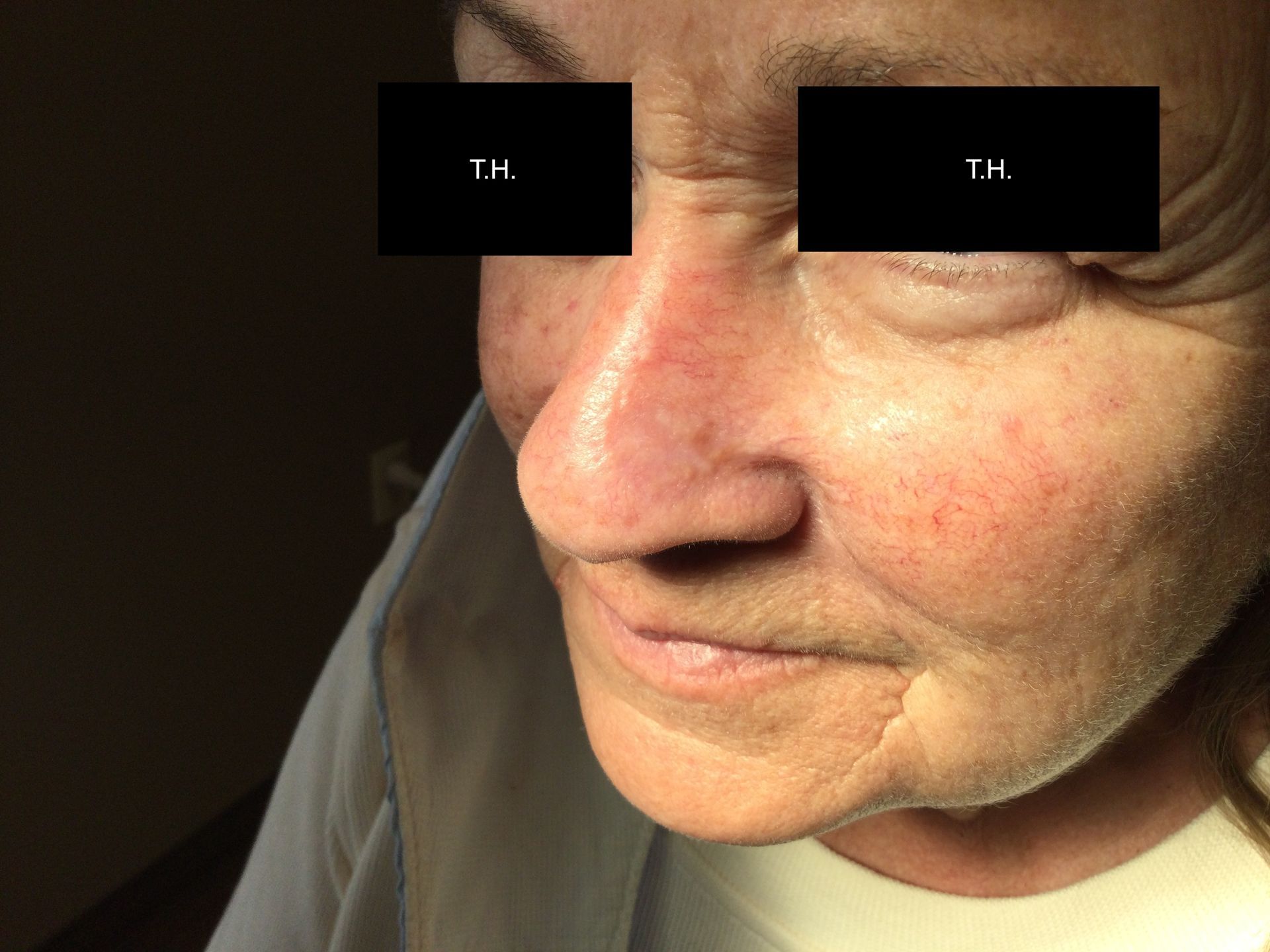 A close up of a woman 's face. 6 month mohs follow up at Advanced Dermatologic Surgery in Overland Park, KS