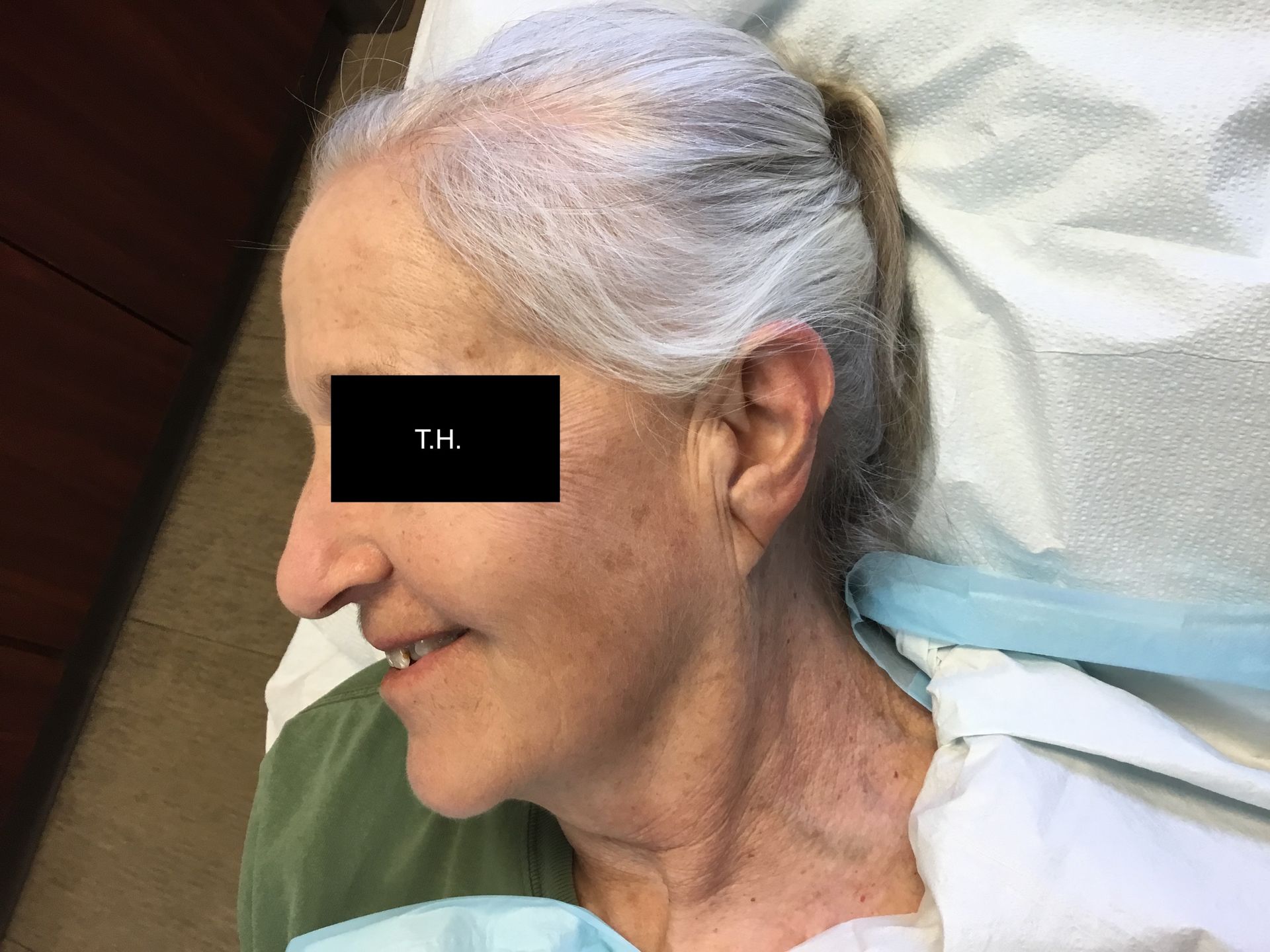 Close-up of a person who had mohs surgery on their ear and has healed Advanced Dermatologic Surgery in Overland Park, KS
