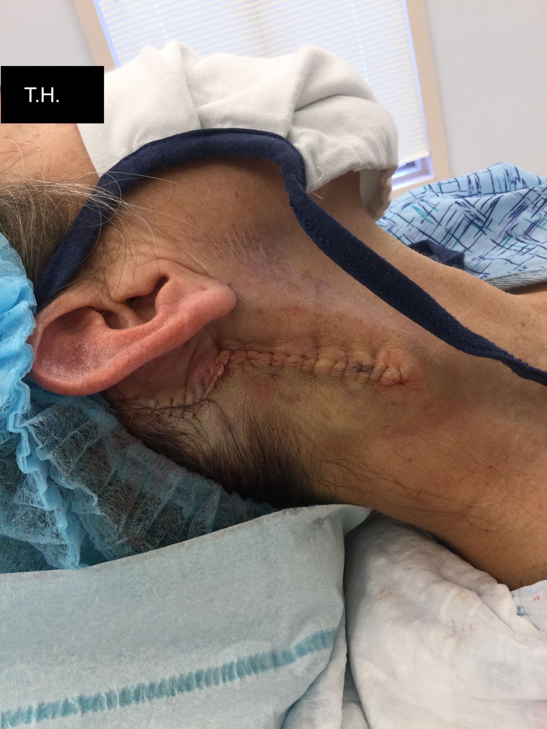 Close up of woman who underwent Mohs Surgery at Advanced Dermatologic Surgery in Overland Park, KS