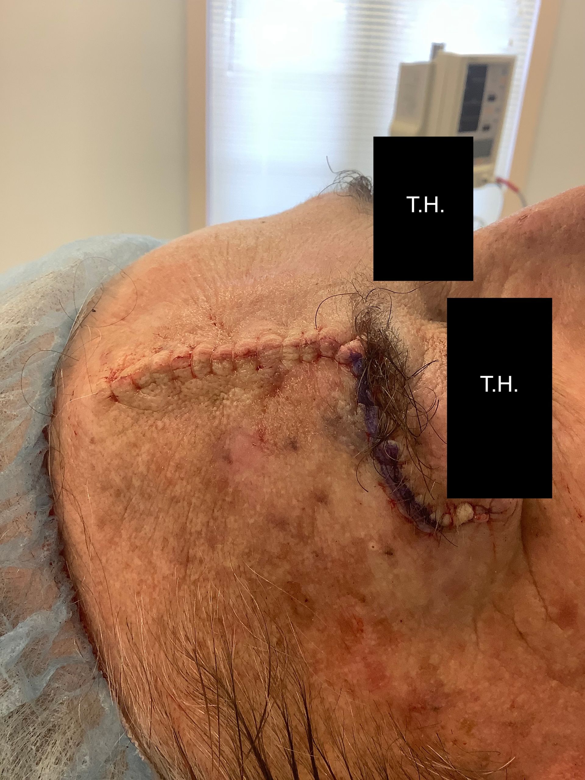 Close up of woman who underwent Mohs Surgery at Advanced Dermatologic Surgery in Overland Park, KS