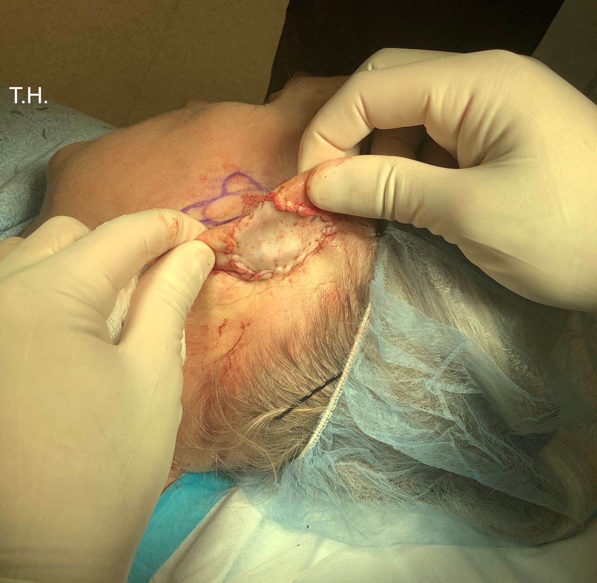 Graft and suture of an ear at Advanced Dermatologic Surgery in Overland Park, KS