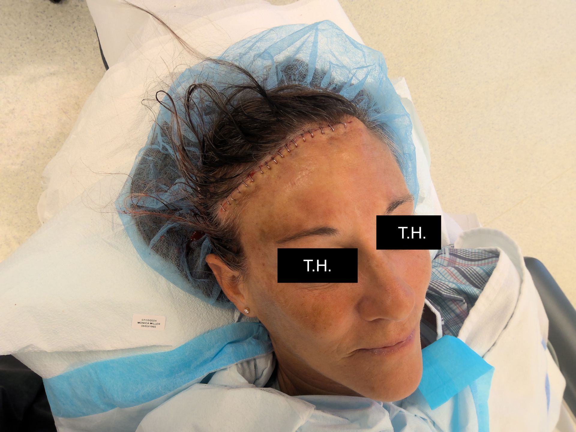 Close up of woman who underwent Mohs Surgery at Advanced Dermatologic Surgery in Overland Park, KS