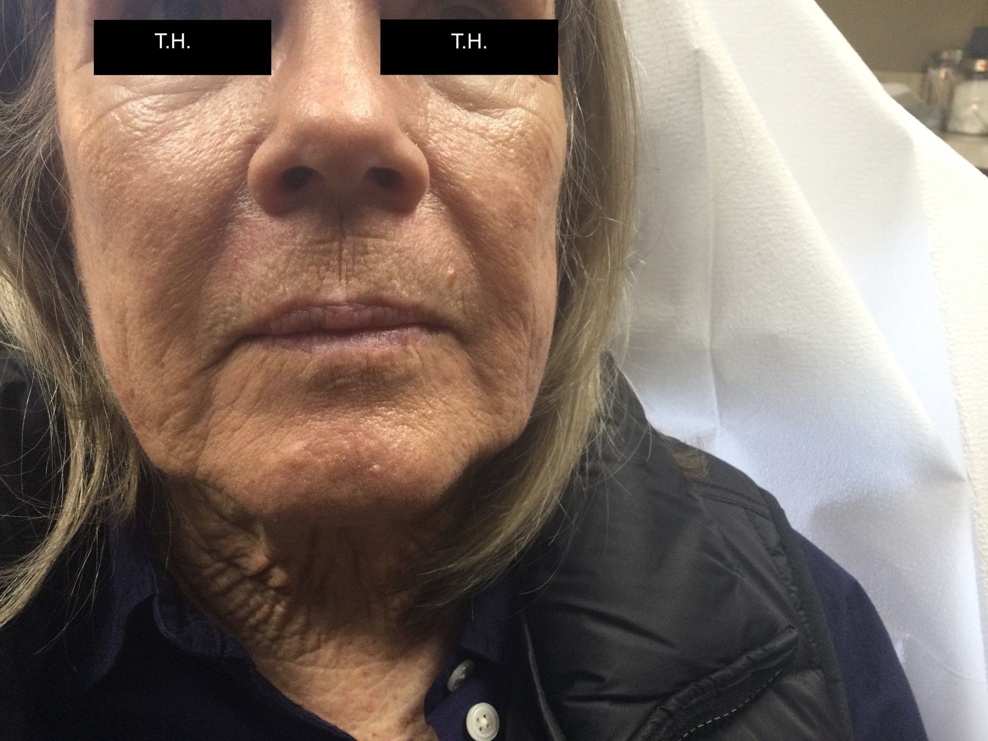 Close up of a woman with minimal scar one year after Mohs Surgery at Advanced Dermatologic Surgery in Overland Park, KS