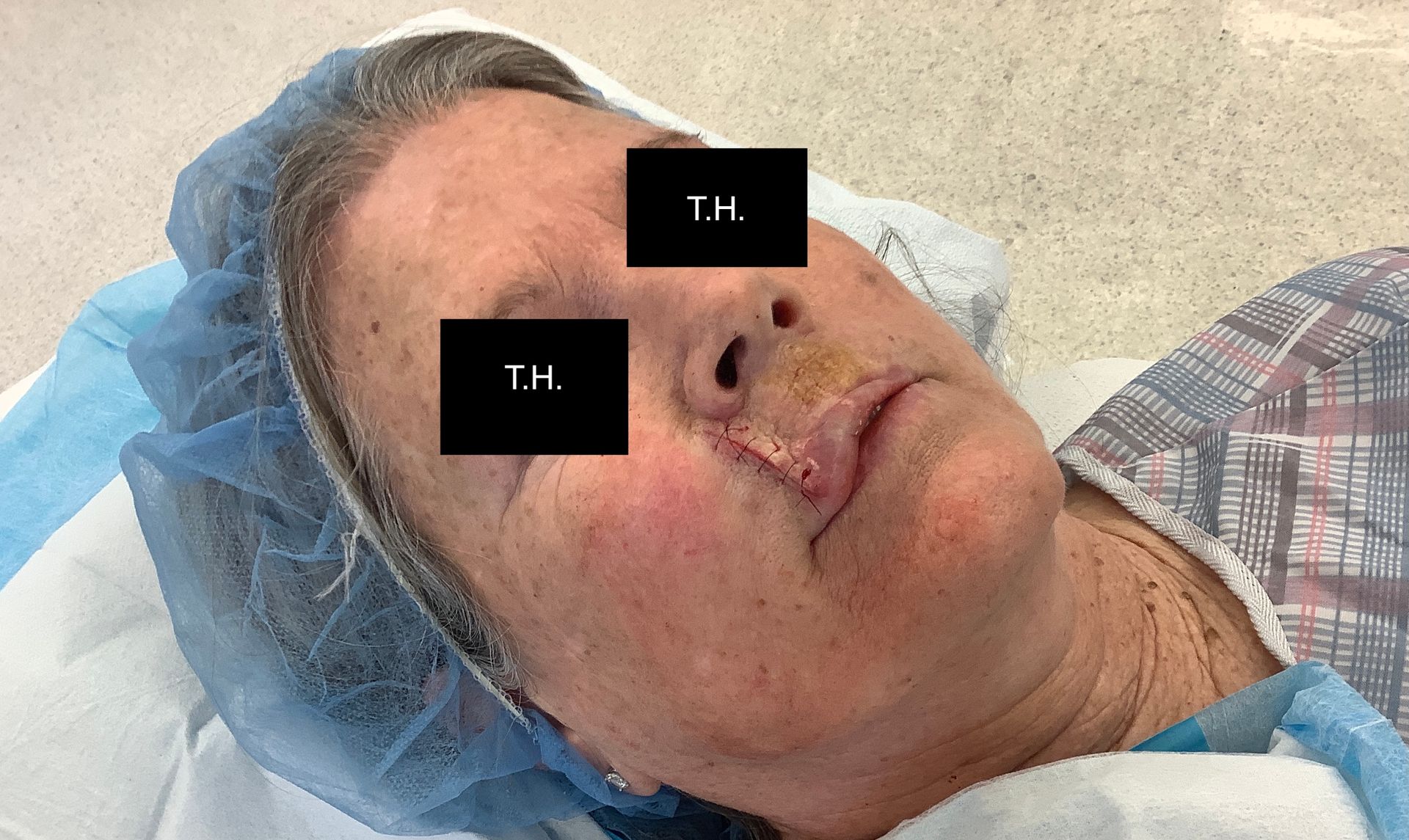 Close up of woman who underwent Mohs Surgery at Advanced Dermatologic Surgery in Overland Park, KS