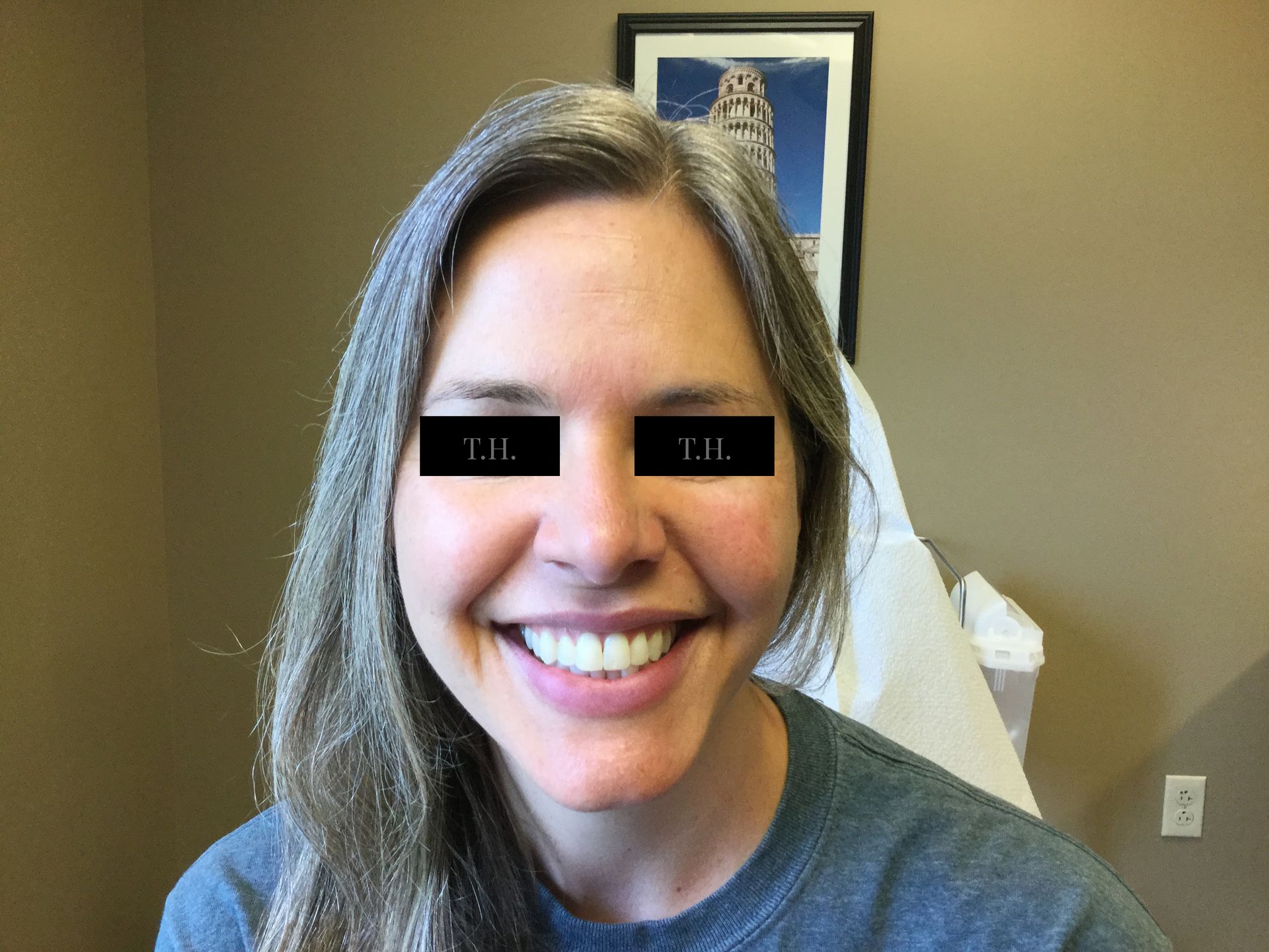 A close up of a woman's face after mohs surgery at Advanced Dermatologic Surgery in Overland Park, KS