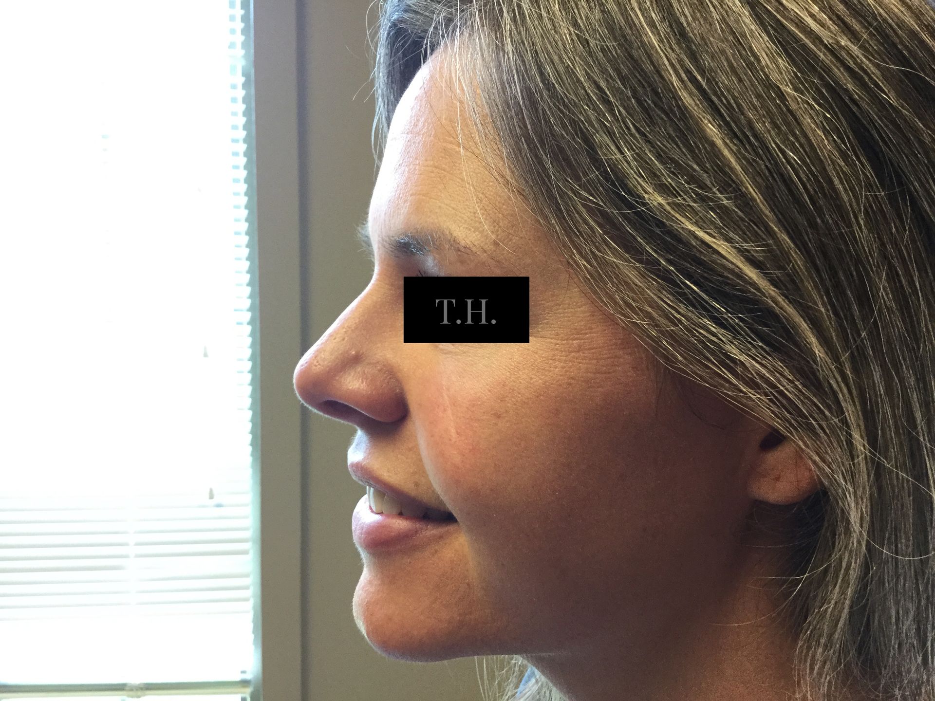 A close up of a woman 's face after Mohs surgery at Advanced Dermatologic Surgery in Overland Park, KS