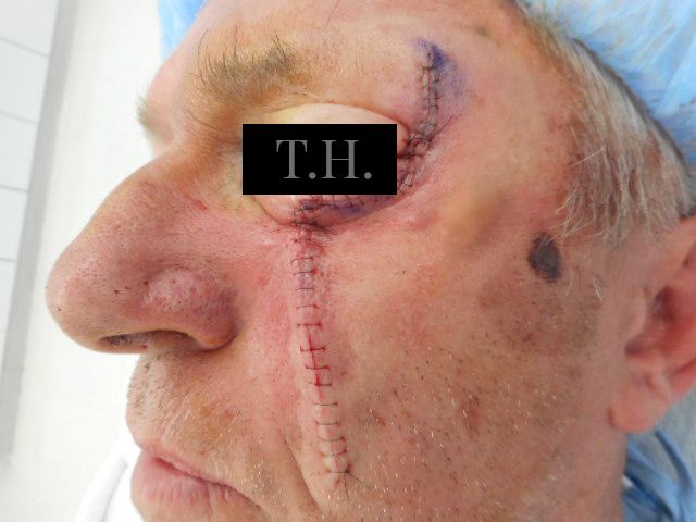 Close up of a man's face immediately following Mohs surgery at Advanced Dermatologic Surgery in Overland Park, KS