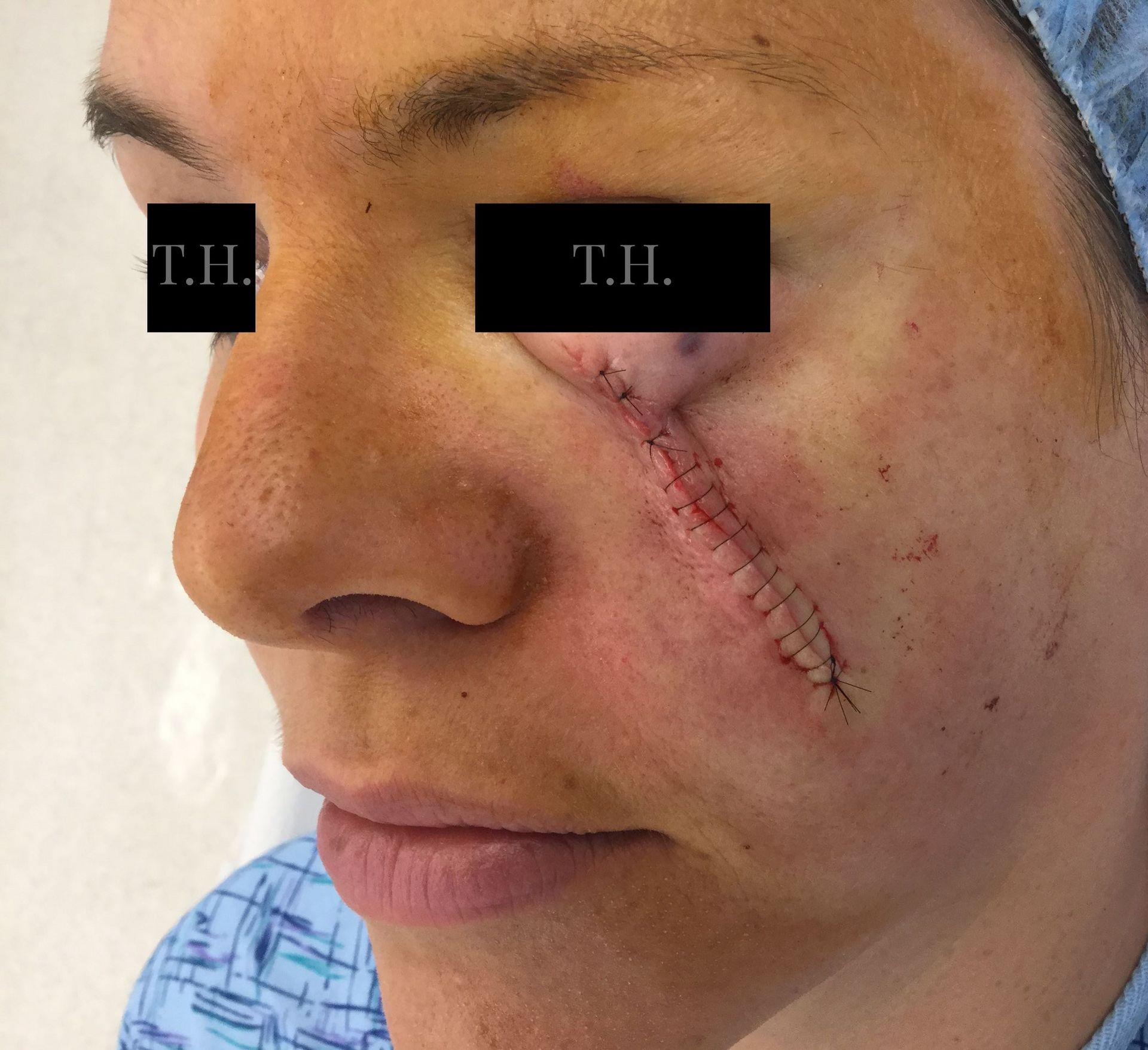 Close up of a woman's face who just underwent Mohs surgery at Advanced Dermatologic Surgery in Overland Park, KS