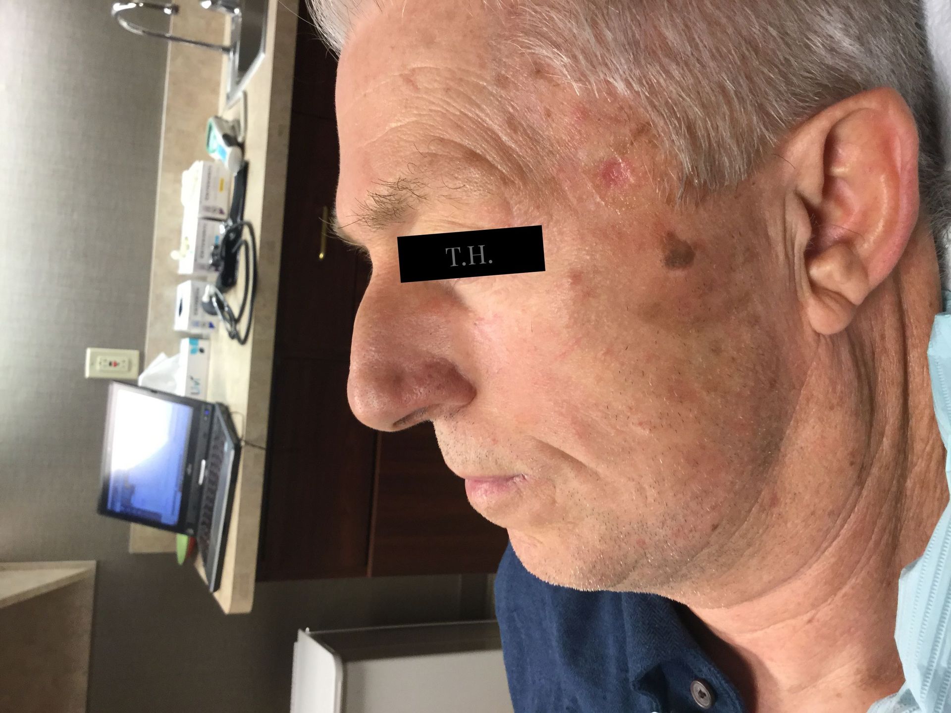 Close up of a man's face immediately following Mohs surgery at Advanced Dermatologic Surgery in Overland Park, KS