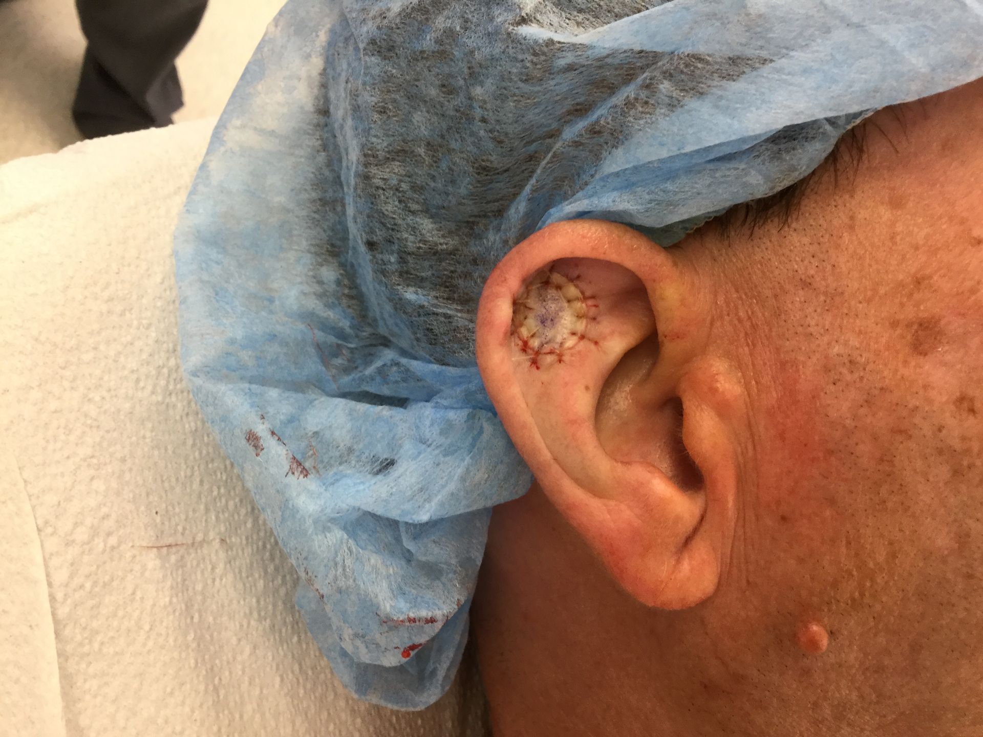 Close up of a man's ear  immediately following Mohs surgery at Advanced Dermatologic Surgery in Overland Park, KS