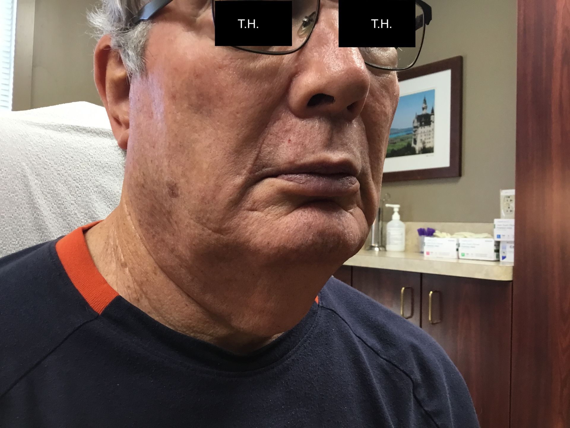 Close up of a woman with minimal scar one year after Mohs Surgery at Advanced Dermatologic Surgery in Overland Park, KS