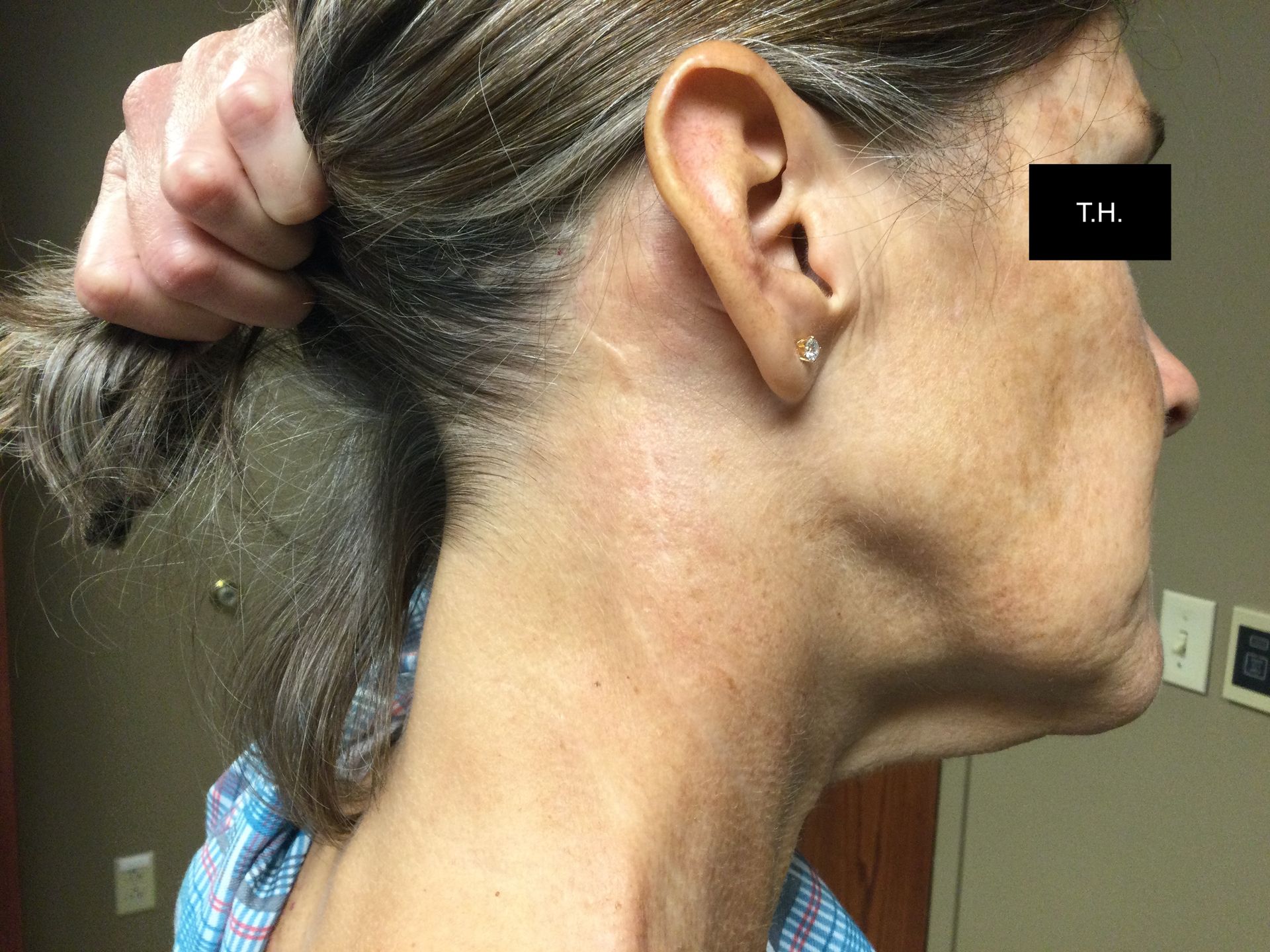 Close up of a woman with minimal scar one year after Mohs Surgery at Advanced Dermatologic Surgery in Overland Park, KS
