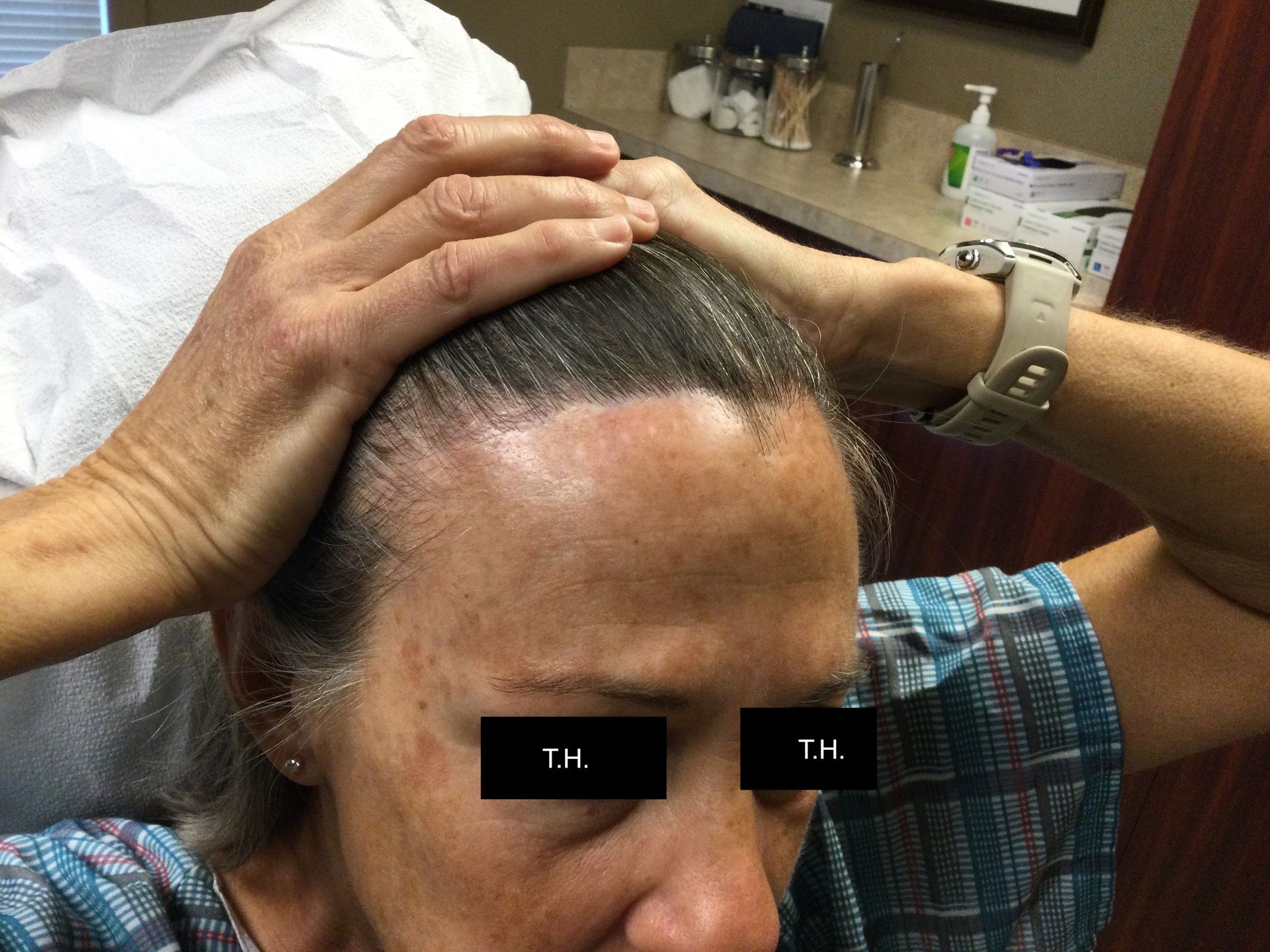 One year follow-up and minimal scar after Mohs Surgery at Advanced Dermatologic Surgery in Overland Park, KS