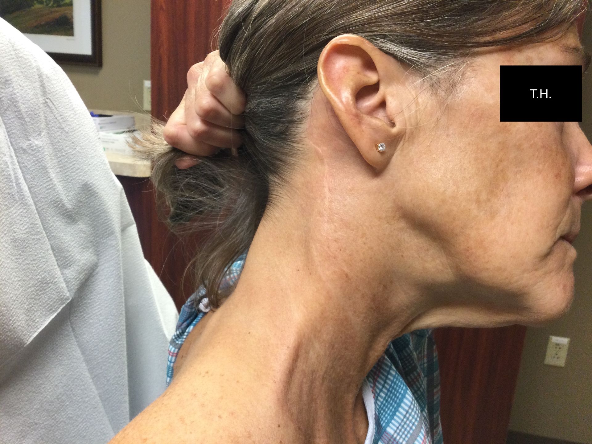 Close up of a woman with minimal scar one year after Mohs Surgery at Advanced Dermatologic Surgery in Overland Park, KS