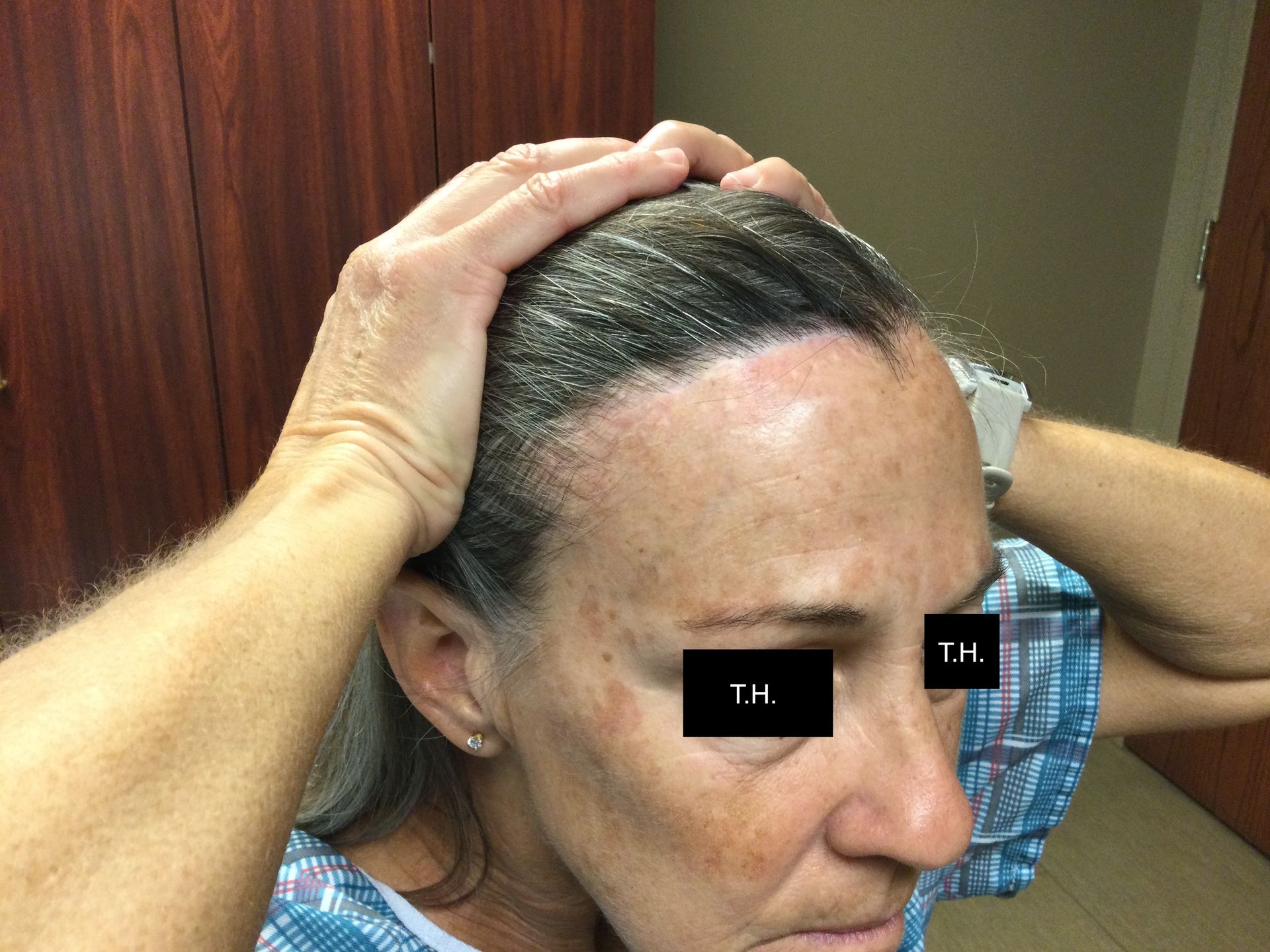 One year post Mohs Surgery at Advanced Dermatologic Surgery in Overland Park, KS.