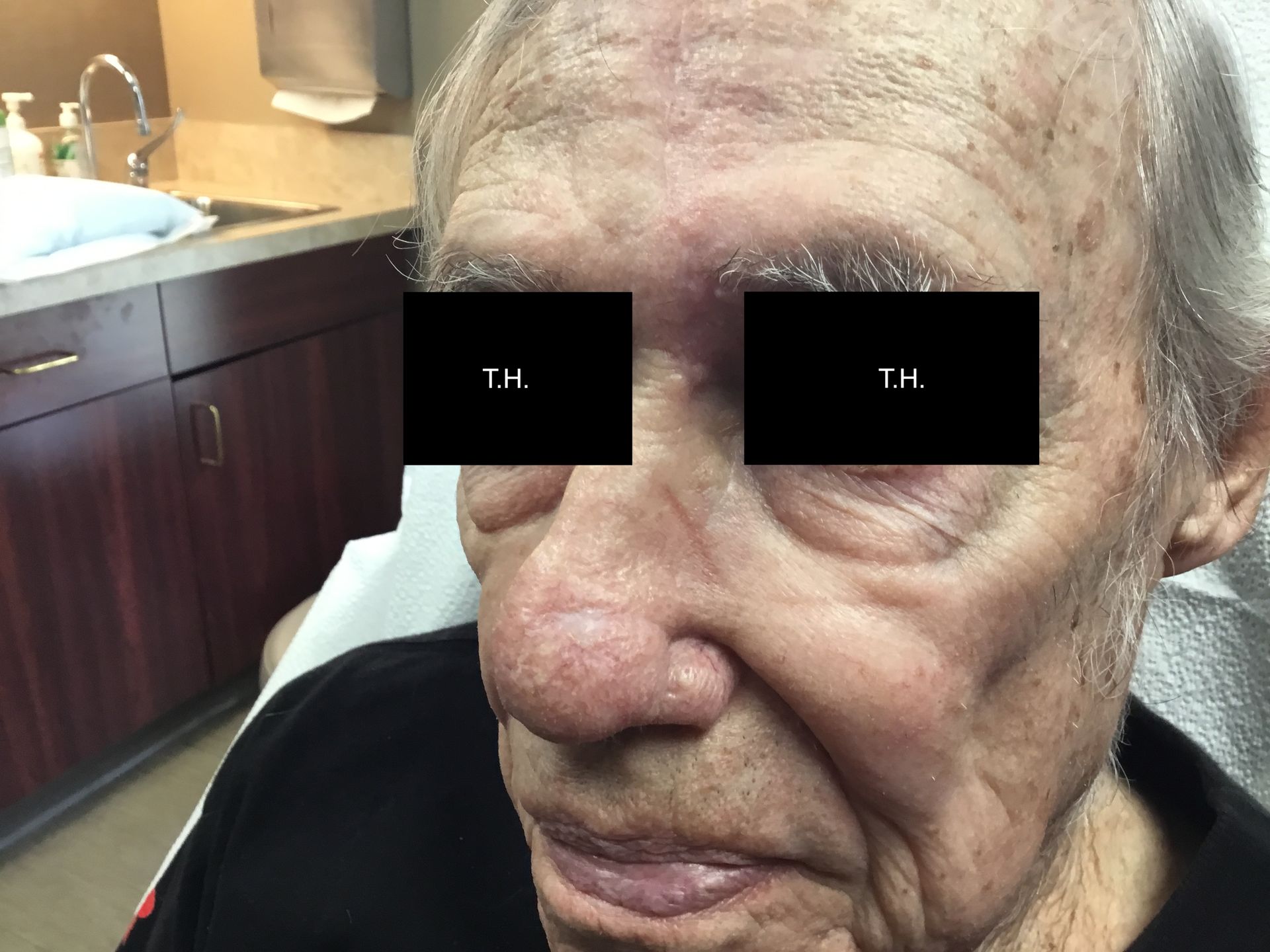 A close-up of a man 's face. 4 month mohs follow up at Advanced Dermatologic Surgery in Overland Park, KS