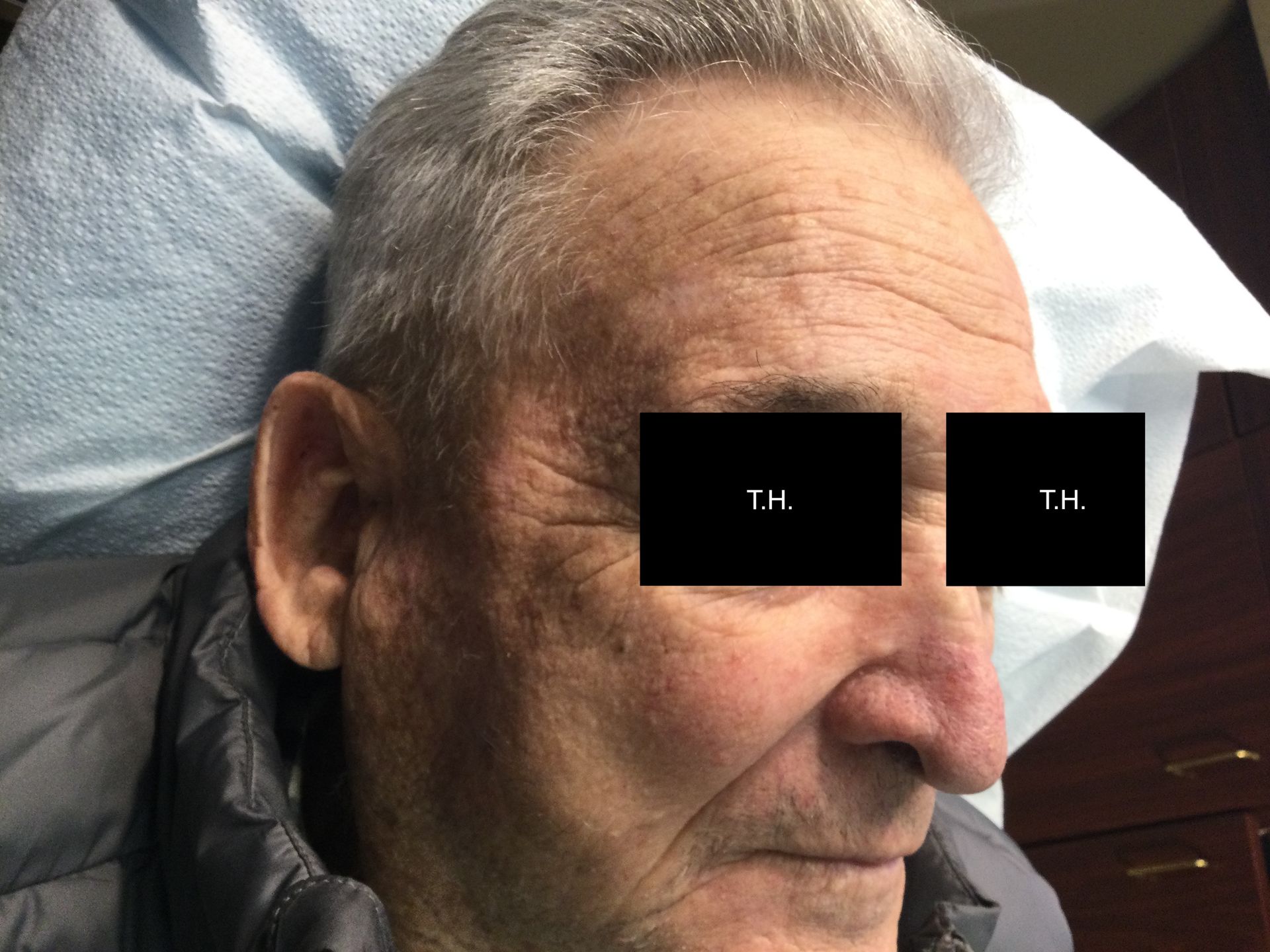 One year follow-up and minimal scar after Mohs Surgery at Advanced Dermatologic Surgery in Overland Park, KS