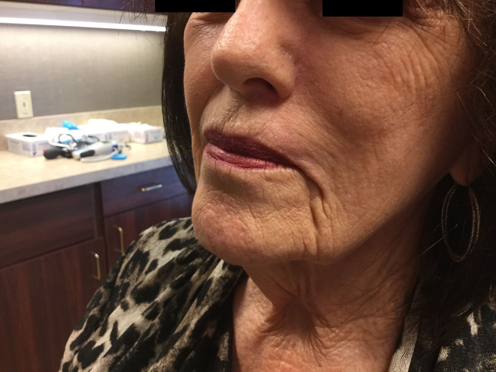 A close up of a woman's face after mohs surgery at Advanced Dermatologic Surgery in Overland Park, KS