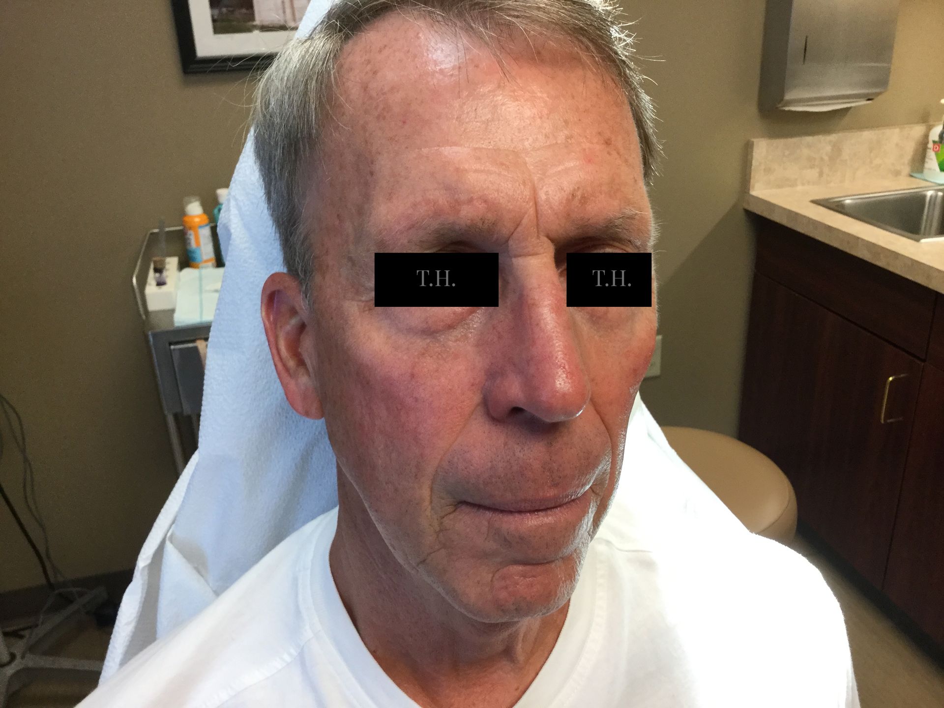 Close up of a man's face after Mohs surgery at Advanced Dermatologic Surgery in Overland Park, KS