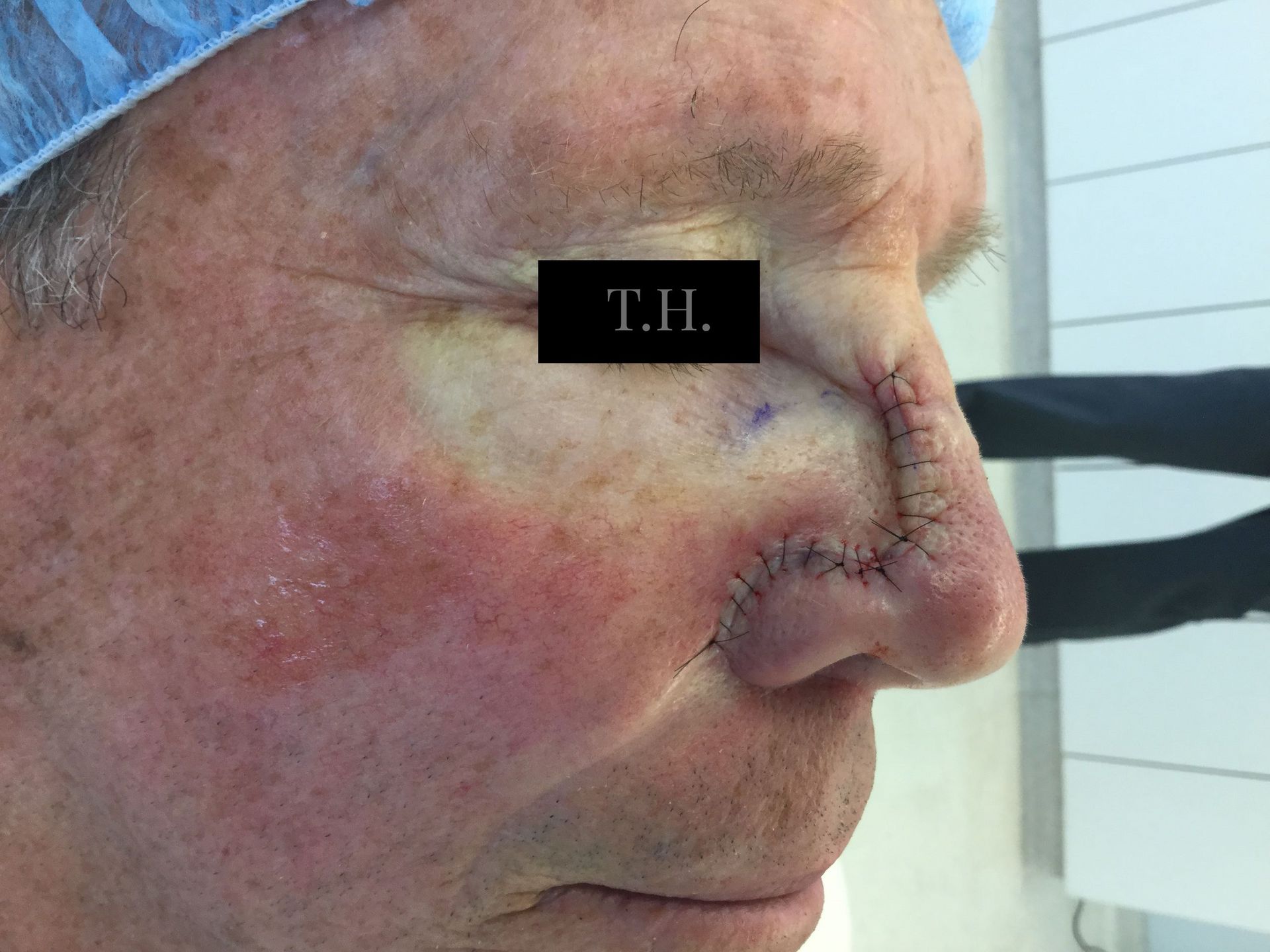 Close up of a man's face immediately following Mohs surgery at Advanced Dermatologic Surgery in Overland Park, KS