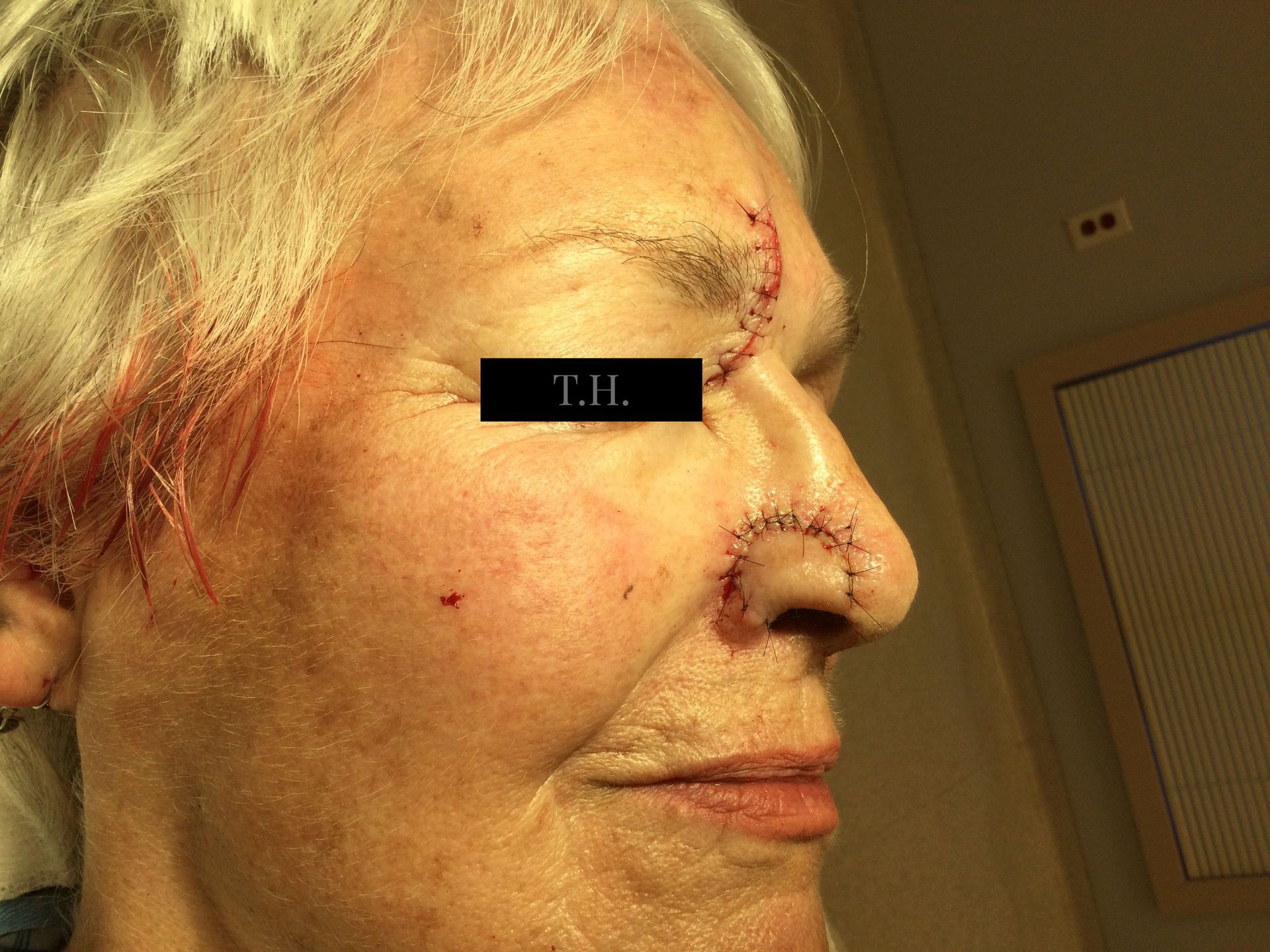 A close up of a woman's face after mohs surgery at Advanced Dermatologic Surgery in Overland Park, KS