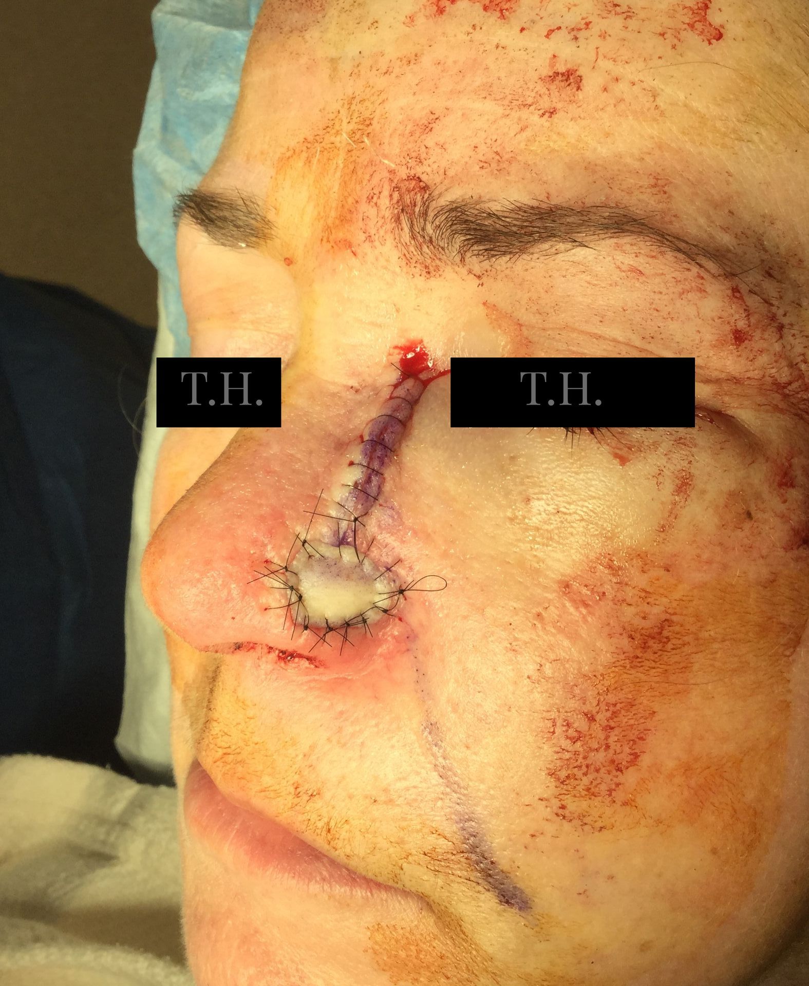Close up of a man's face immediately following Mohs surgery at Advanced Dermatologic Surgery in Overland Park, KS