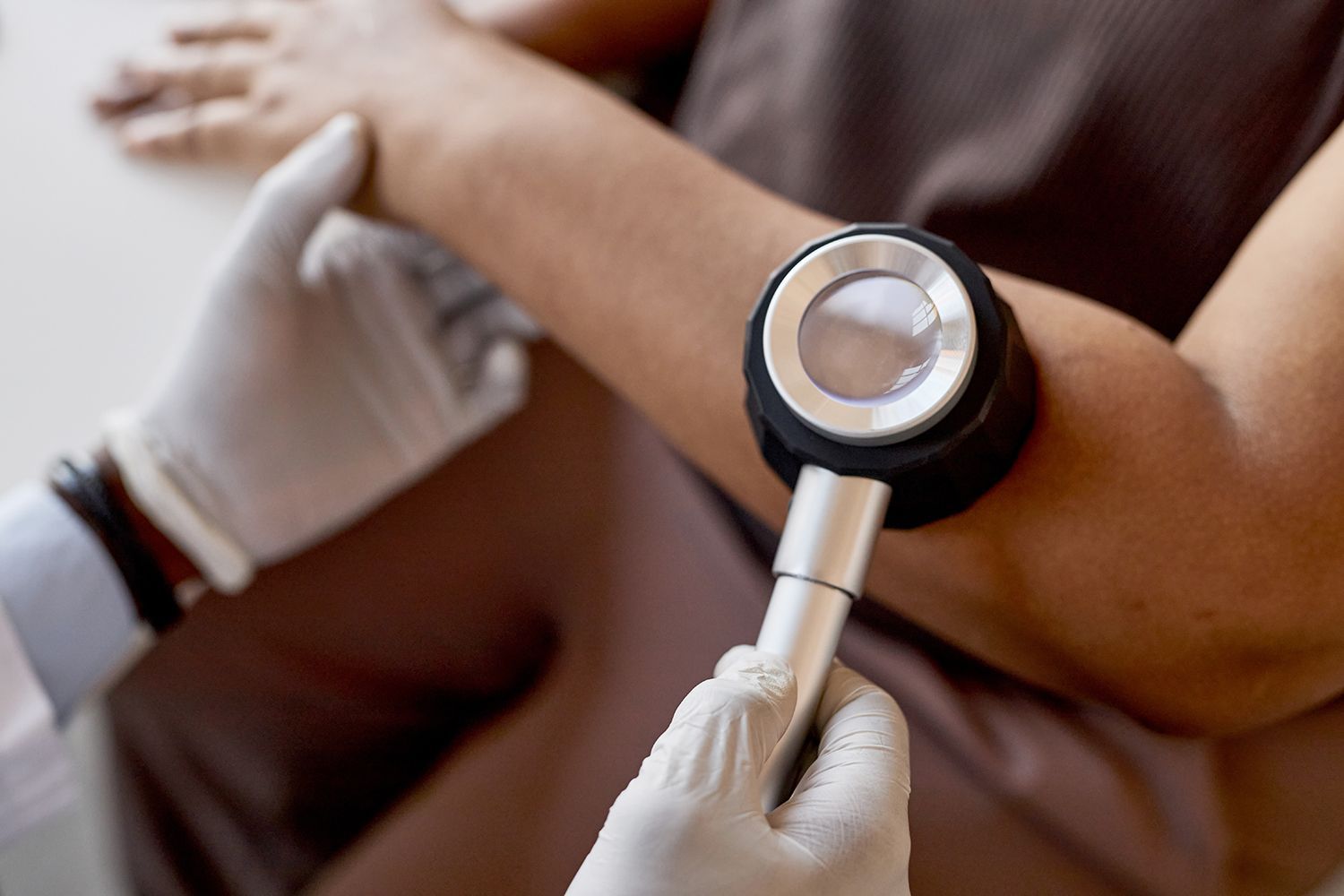 Doctor using a dermatoscope to examine a patient's arm, checking for skin irregularities.