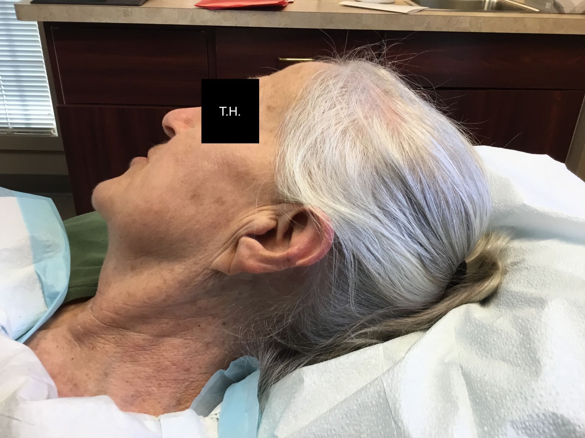 A close up of a woman 's ear at a 4 year follow up at Advanced Dermatologic Surgery in Overland Park, KS