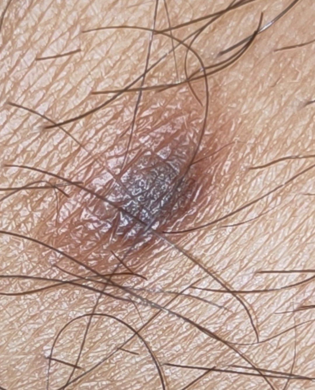 Pigmented dermatofibroma on the lower leg showing a firm, brown skin lesion
