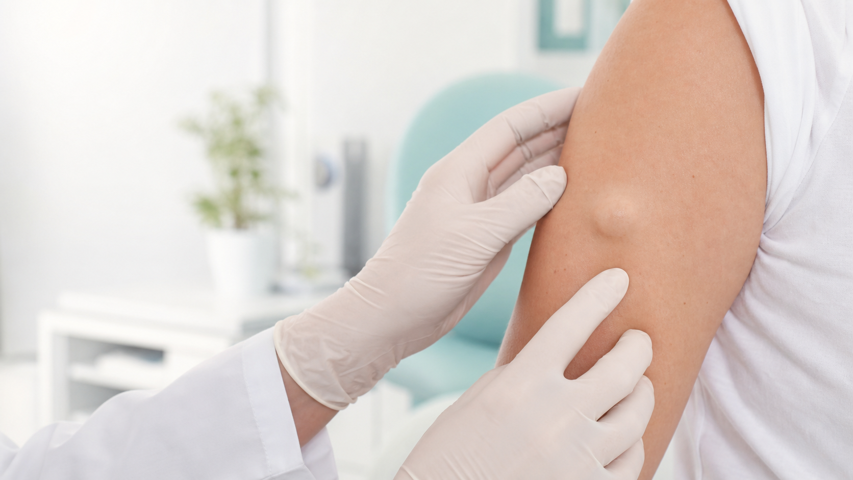 A dermatologic surgeon examining a soft, skin-colored lipoma on a patient's upper arm