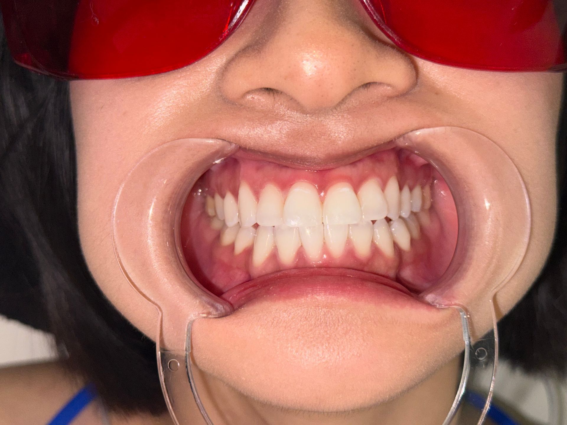 A close up of a person 's mouth with white teeth.
