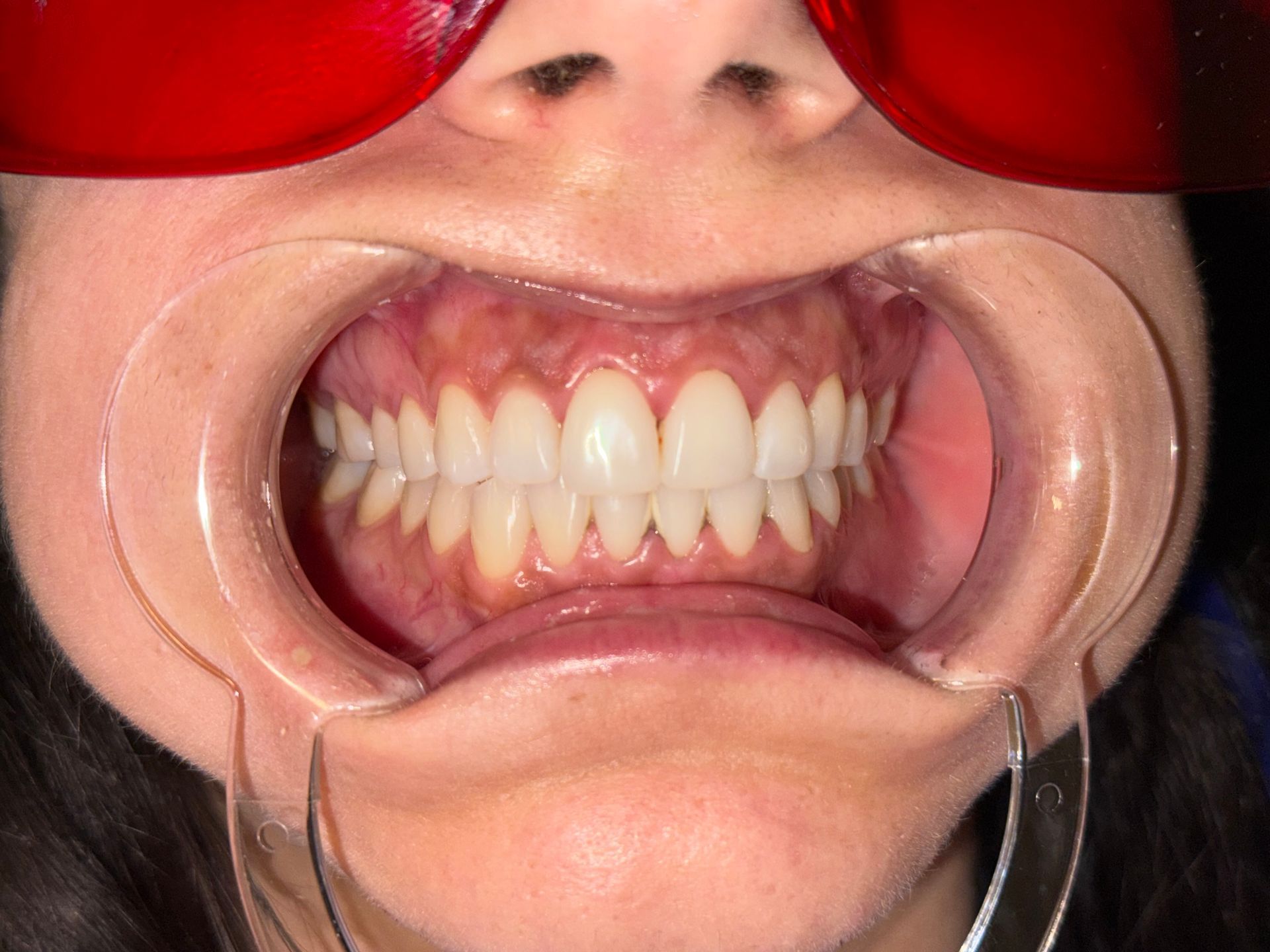 A close up of a person 's mouth with white teeth.