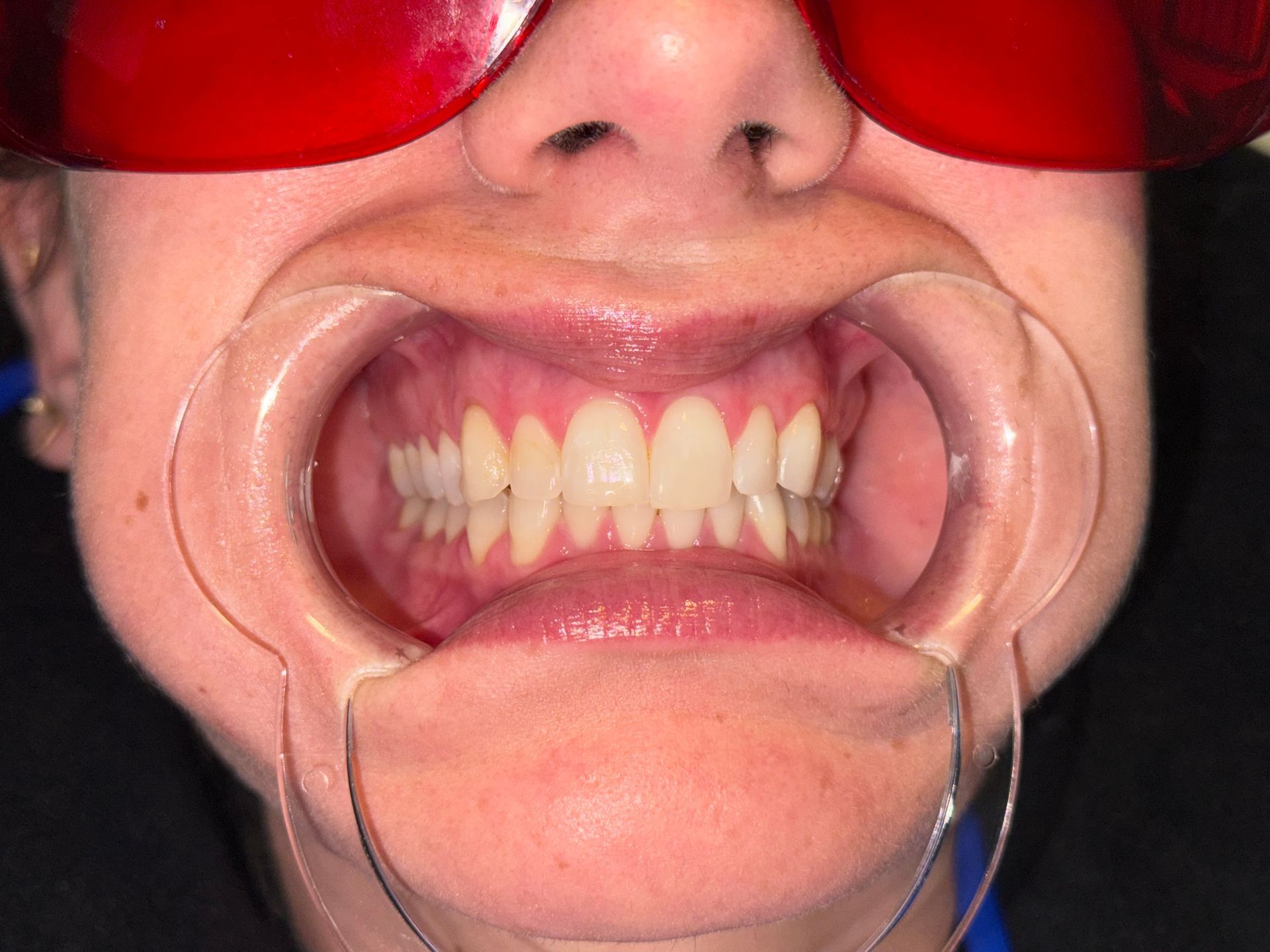 A close up of a person 's mouth with white teeth.
