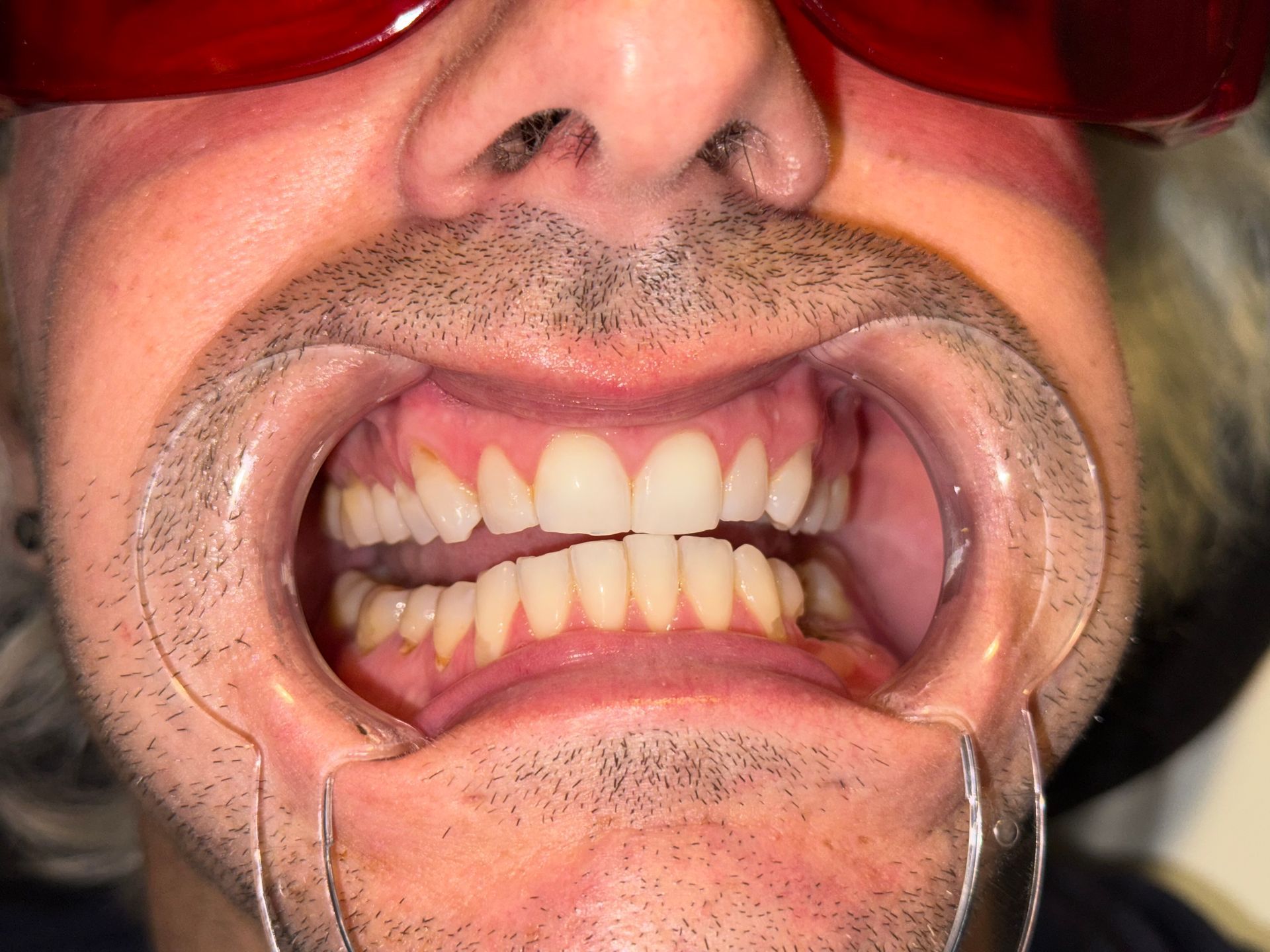 A close up of a person 's mouth with white teeth.