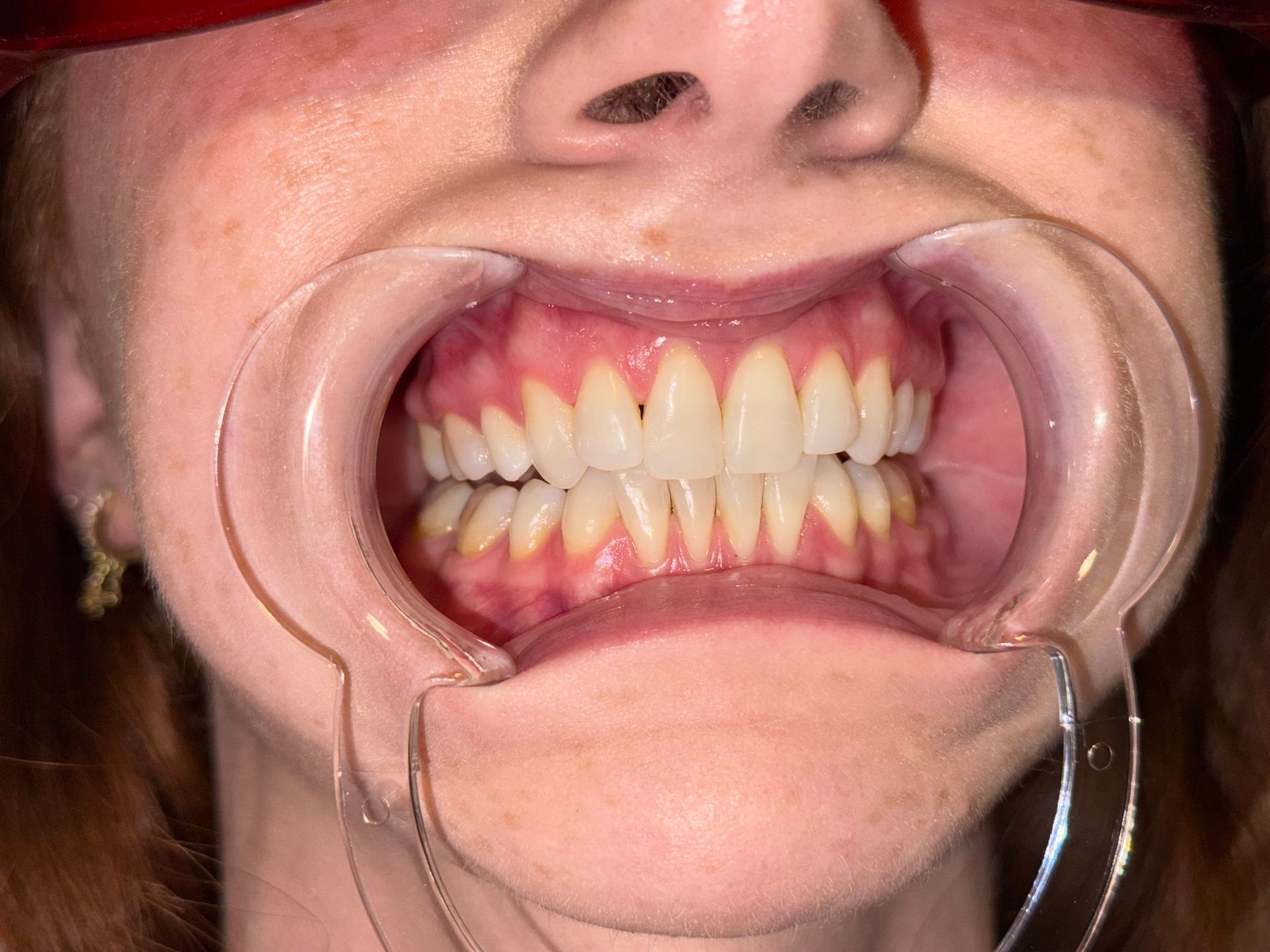 A close up of a person 's mouth with white teeth.
