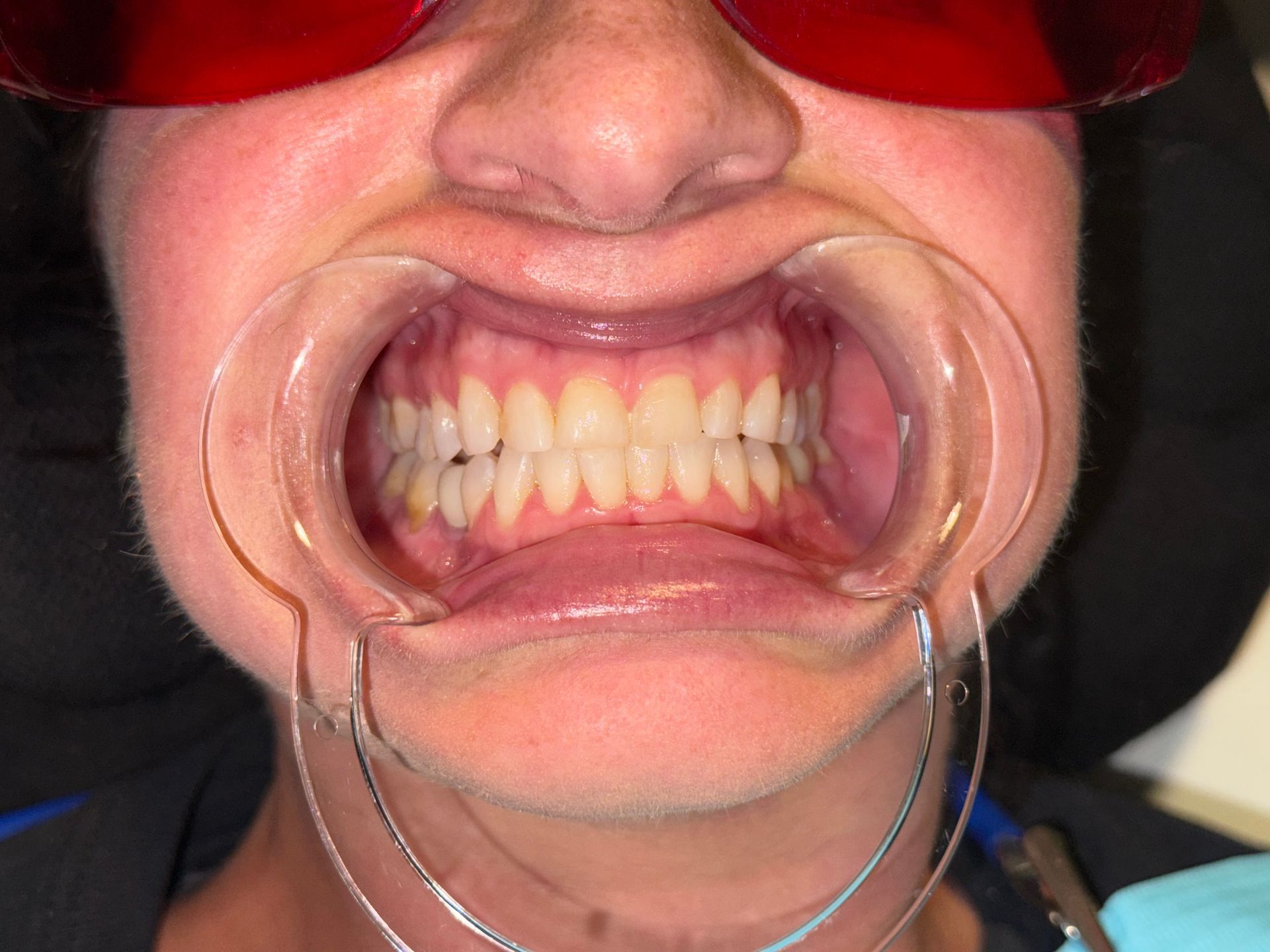 A close up of a person 's mouth with white teeth.