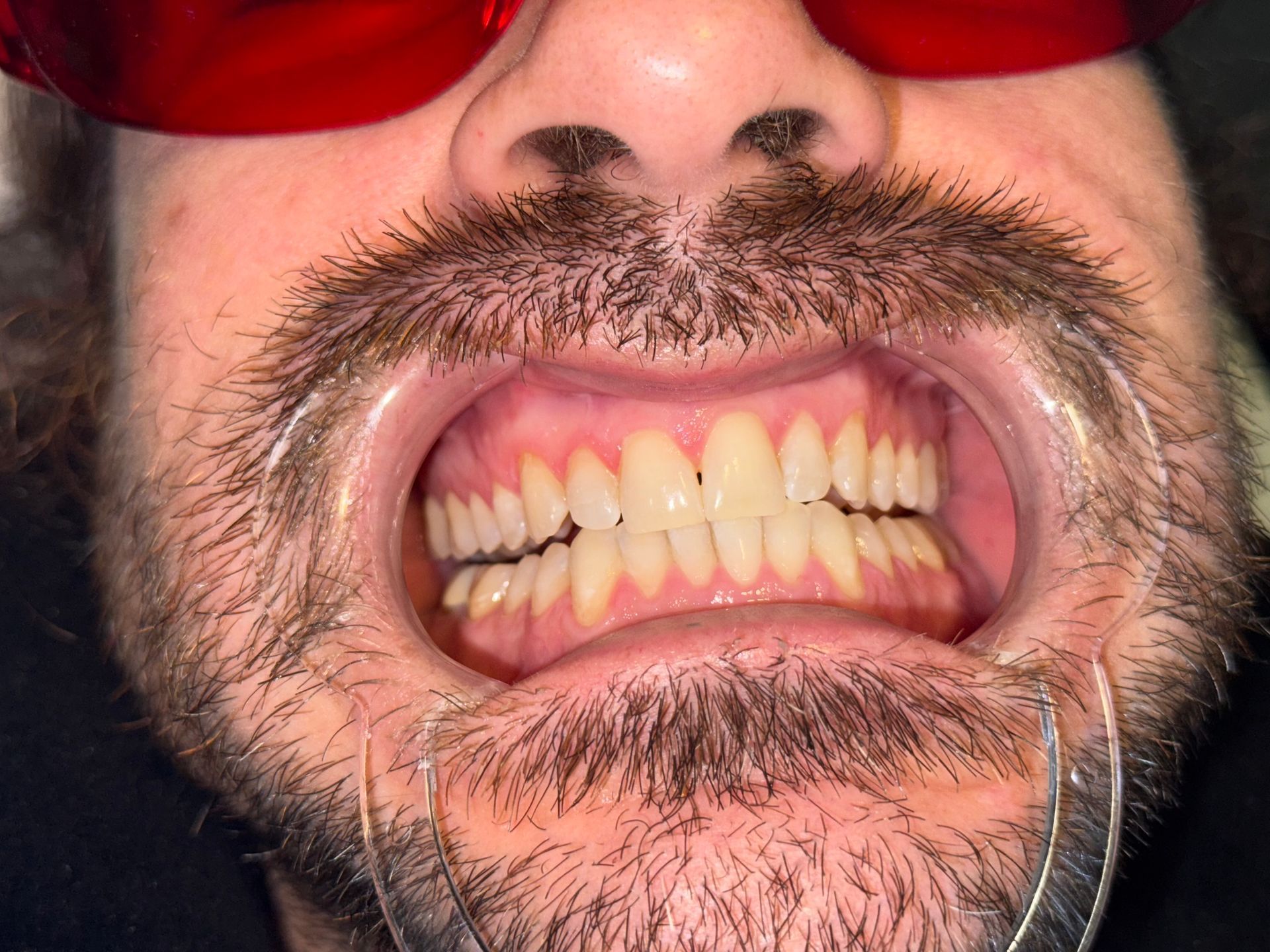A close up of a person 's mouth with white teeth.