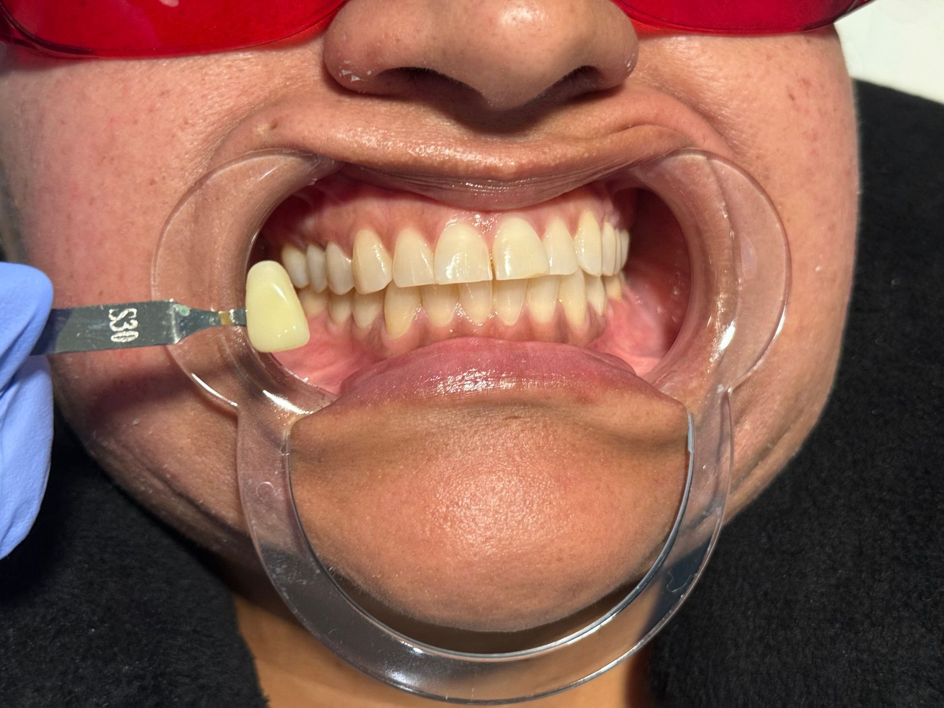 A close up of a person 's mouth with white teeth.
