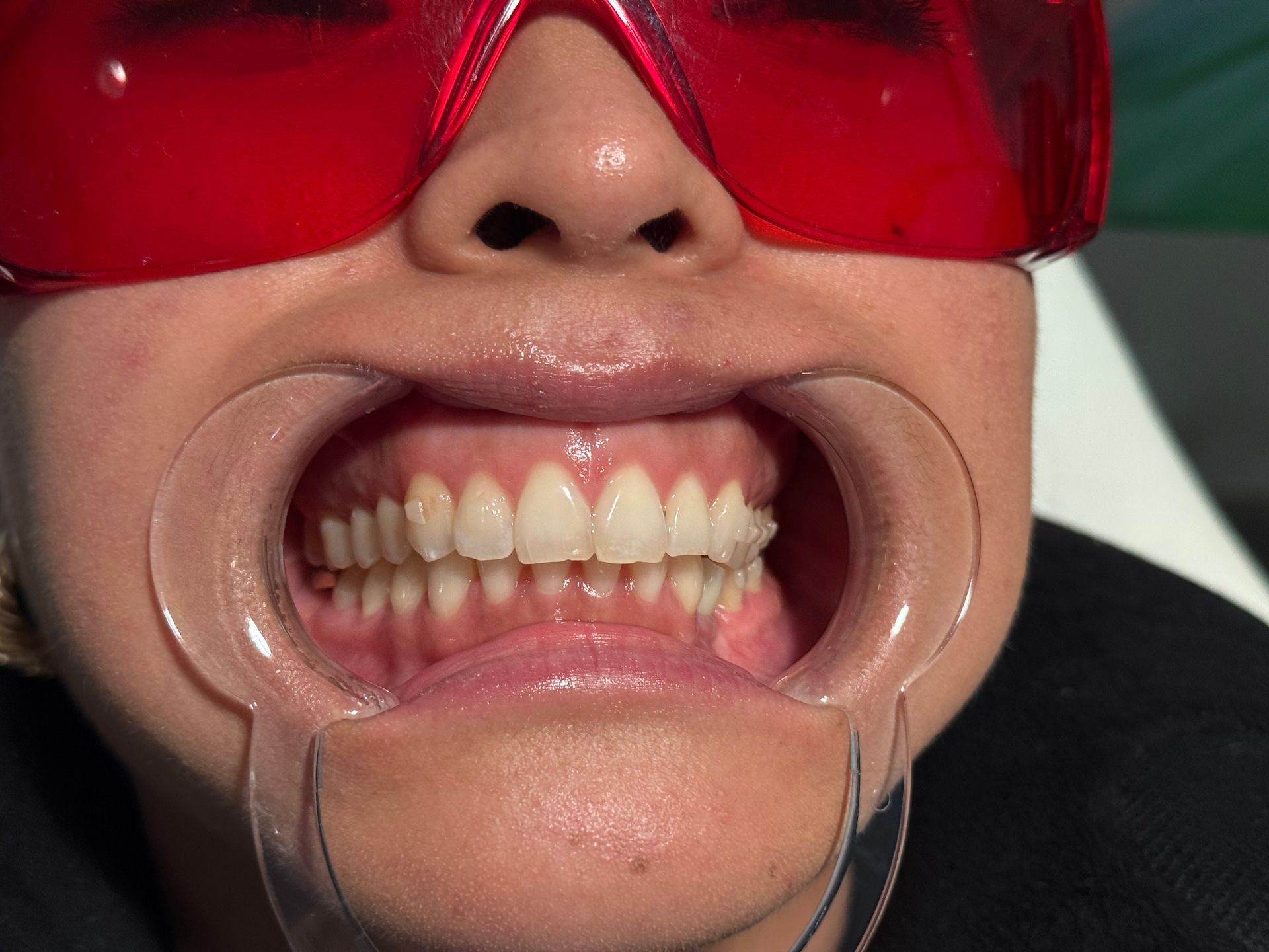 A close up of a person 's mouth with white teeth.