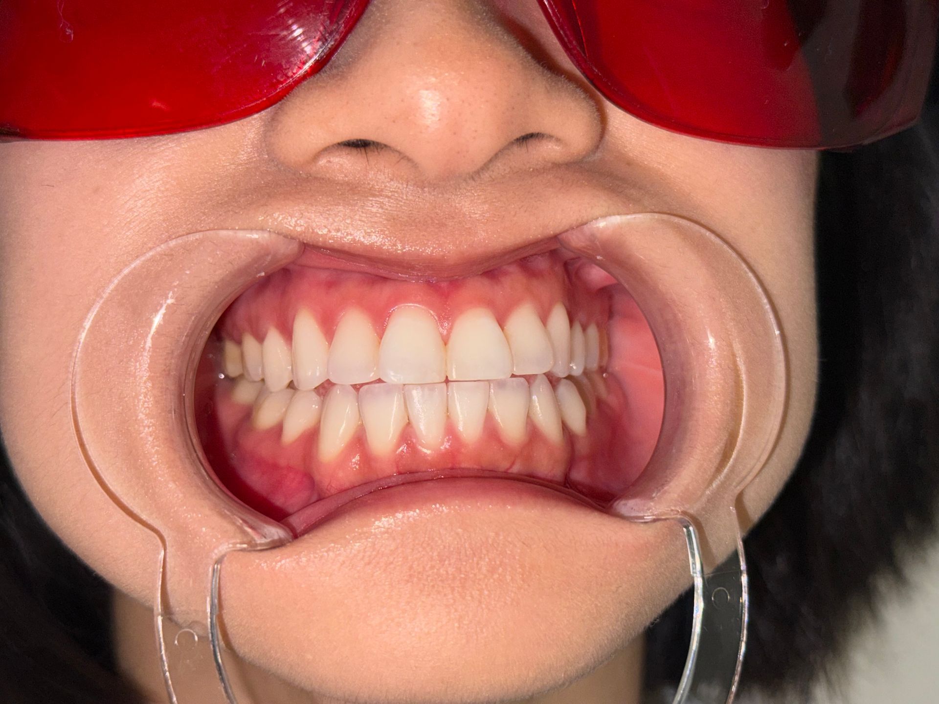 A close up of a person 's mouth with white teeth.