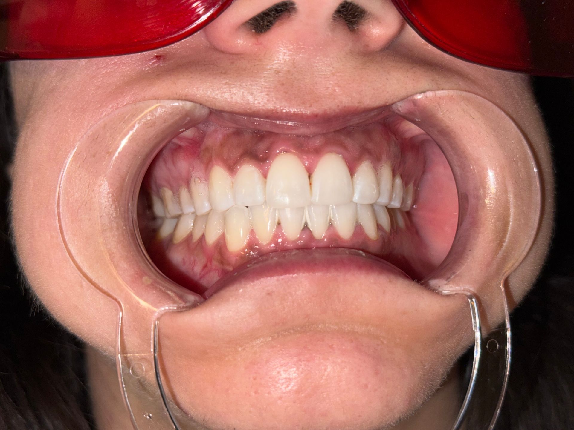 A close up of a person 's mouth with white teeth.