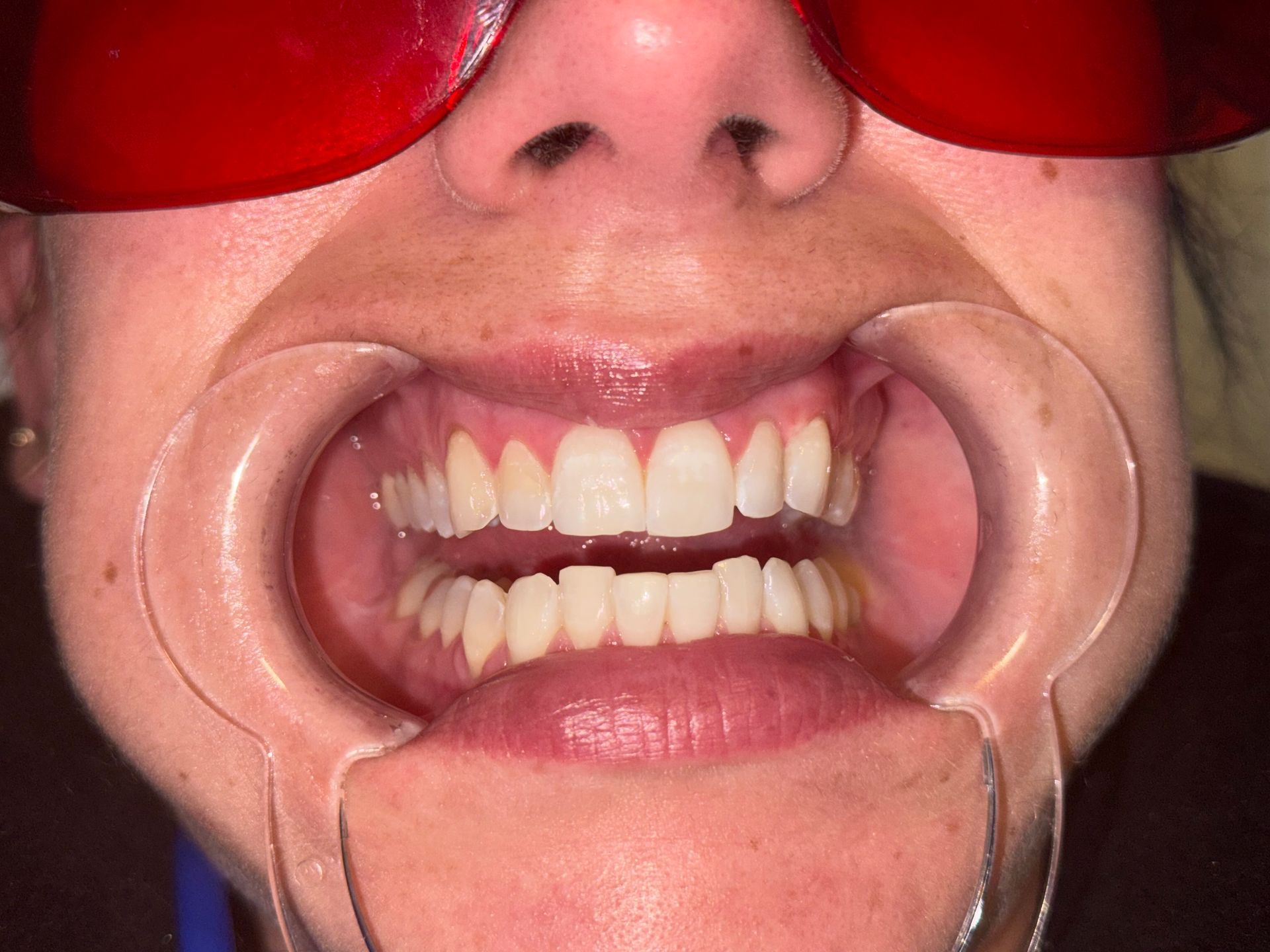 A close up of a person 's mouth with white teeth.