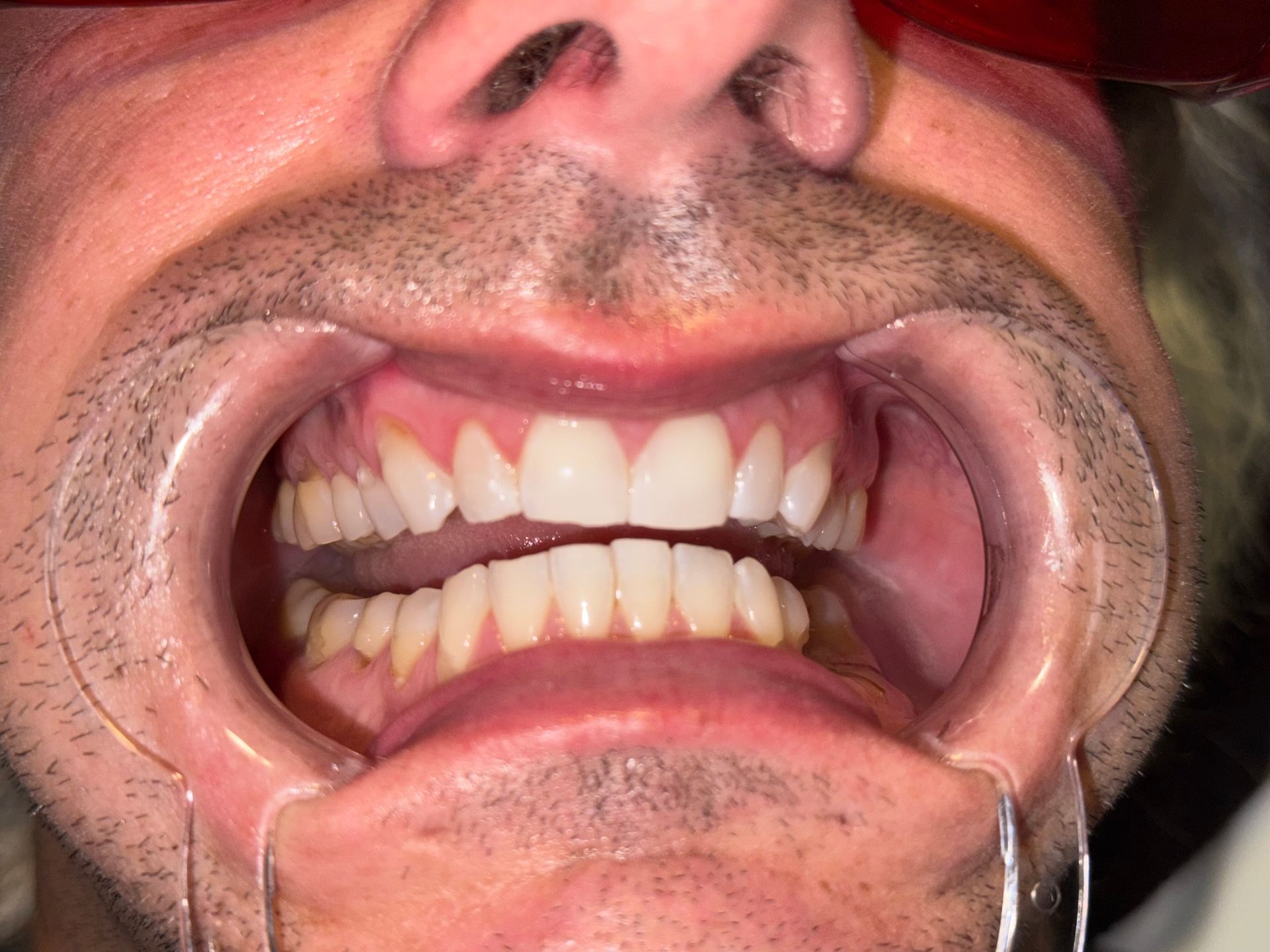 A close up of a person 's mouth with white teeth.