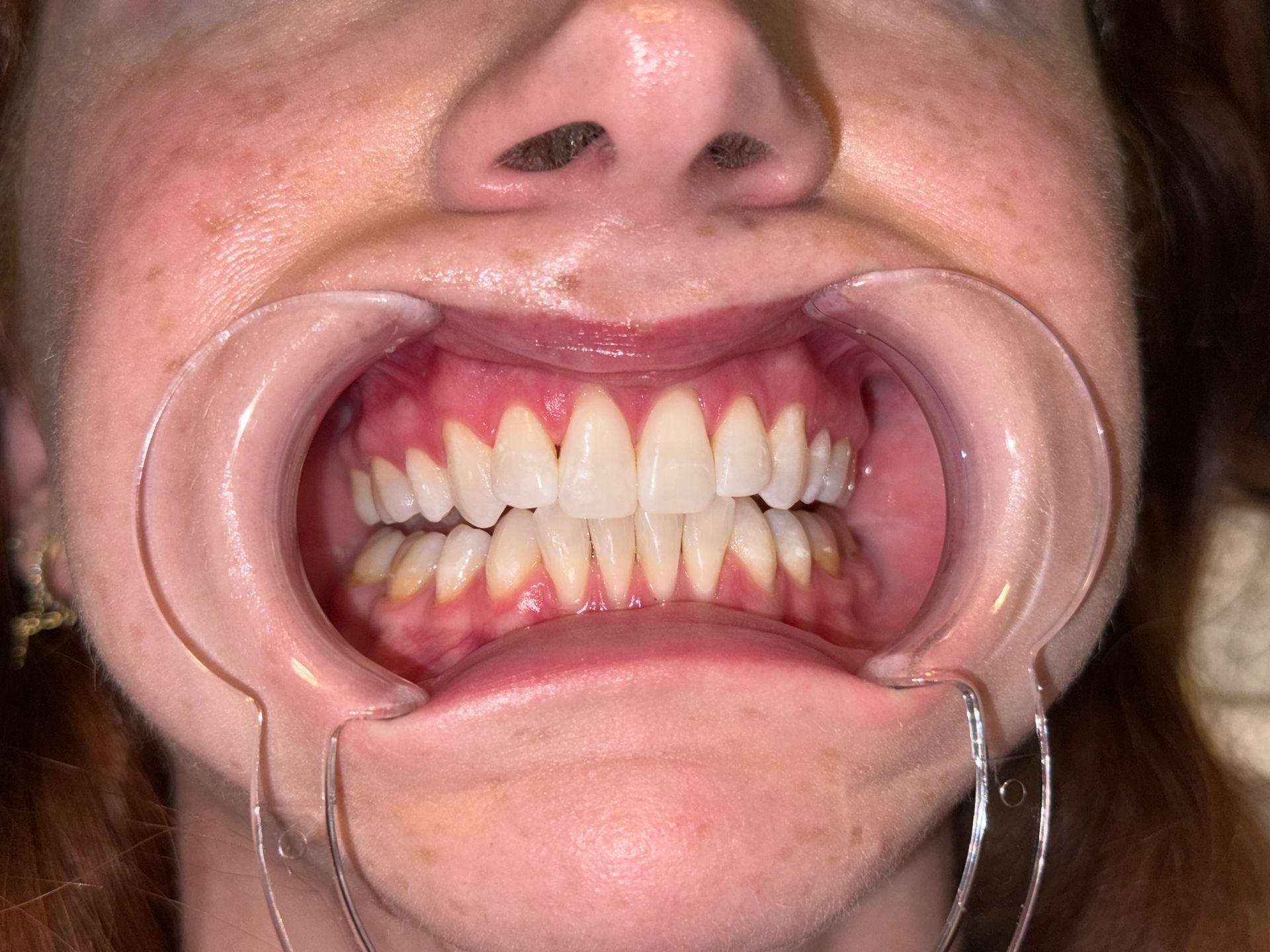 A close up of a person 's mouth with white teeth.