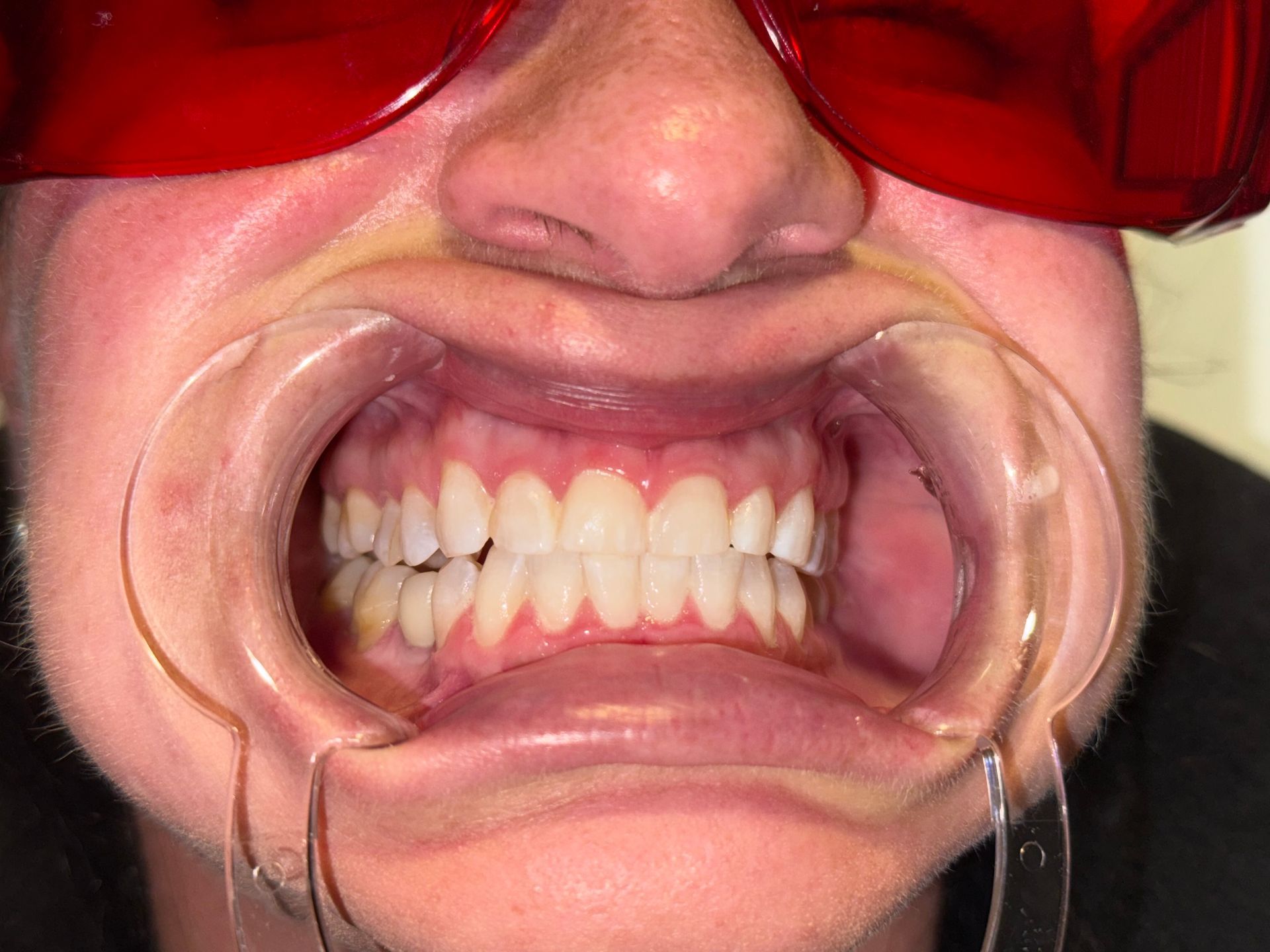 A close up of a person 's mouth with white teeth.