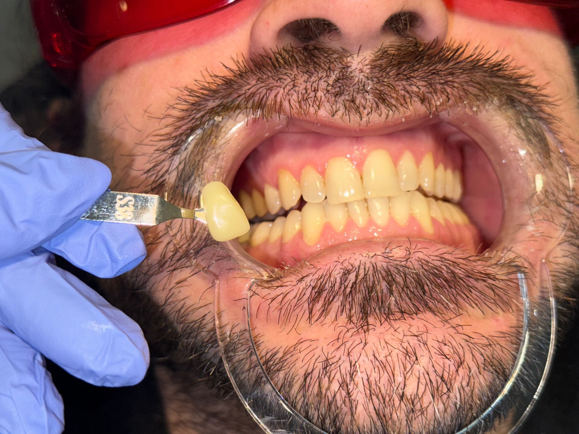 A close up of a person 's mouth with white teeth.