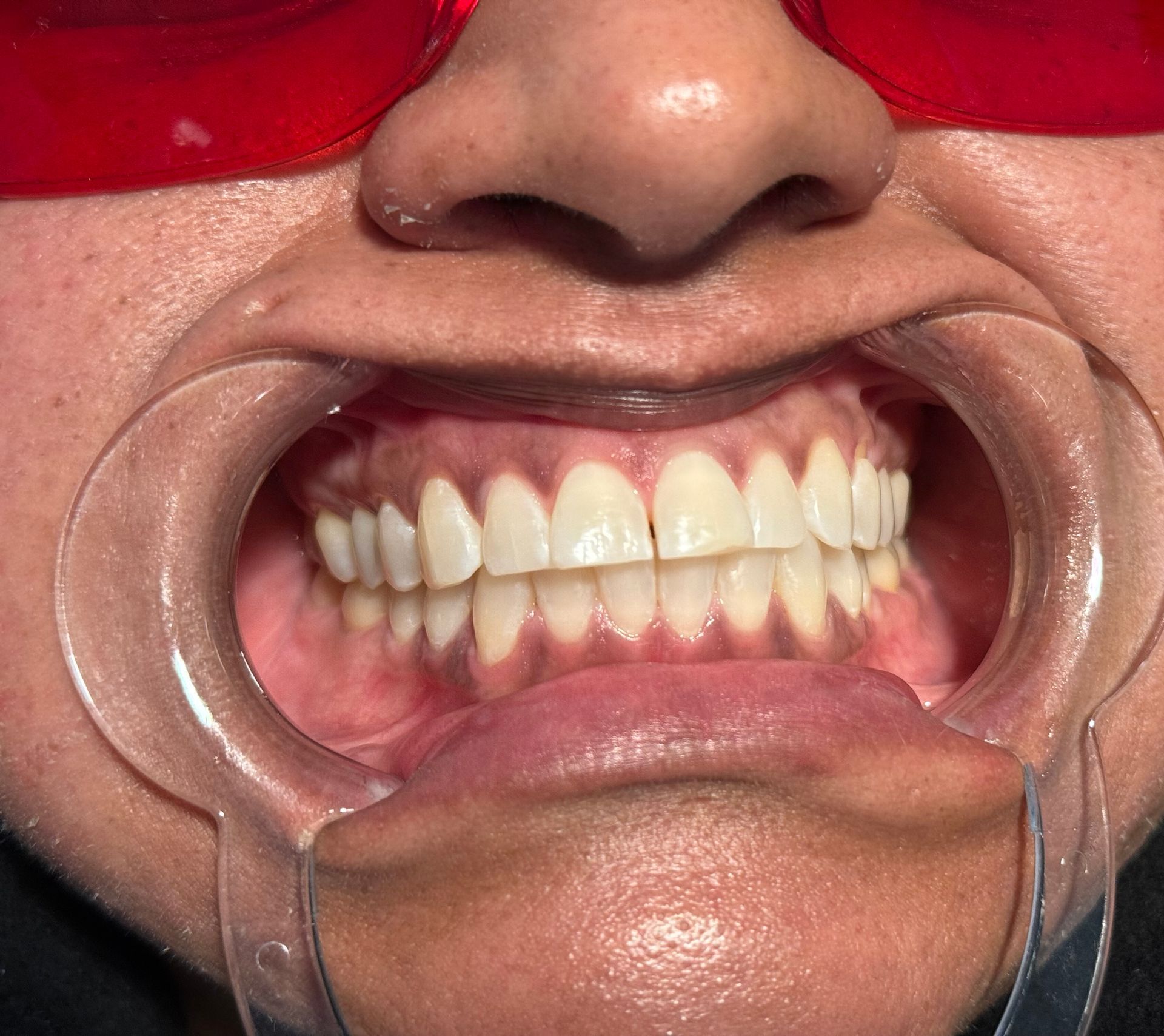 A close up of a person 's mouth with white teeth.