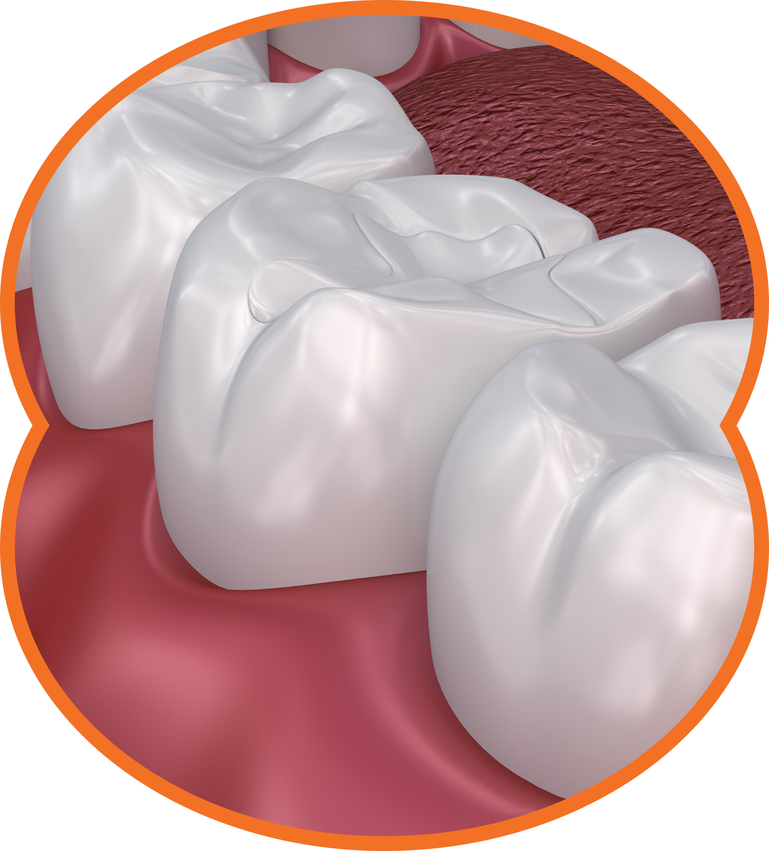 Close-up of teeth, highlighting molars and gums with an orange border.