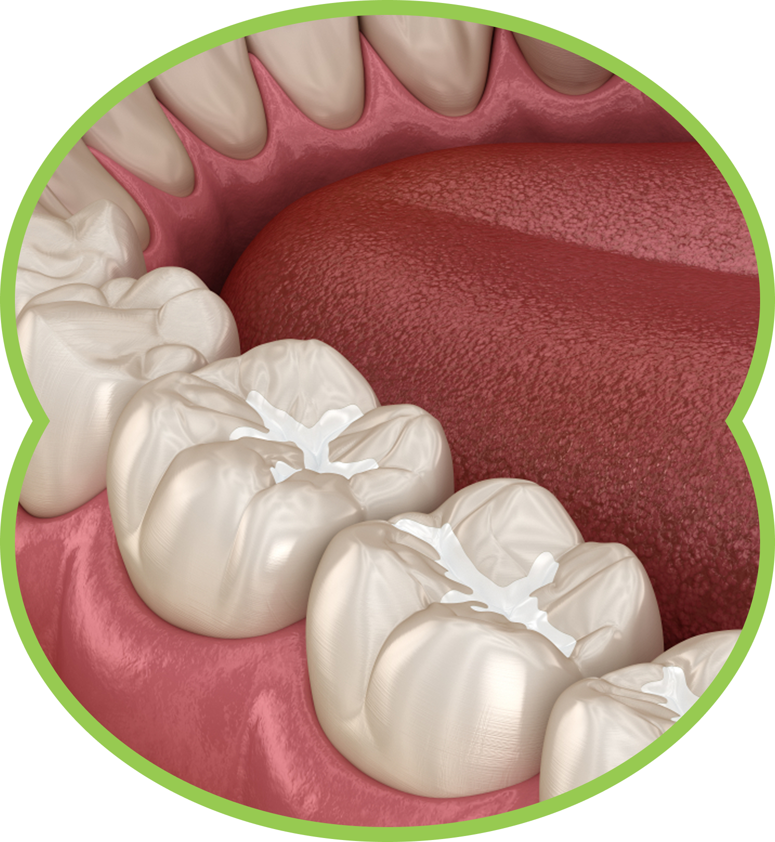 Close-up of teeth with white fillings in the molars; inside of the mouth, pink and tan colors.