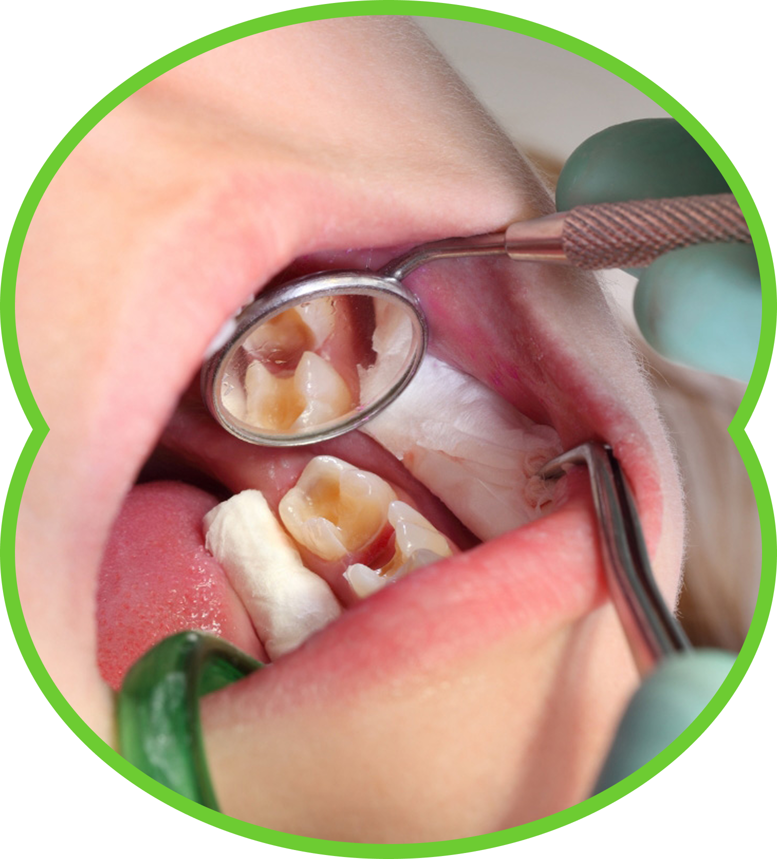 Close-up of a person's mouth showing teeth with visible decay and brown spots, likely cavities.